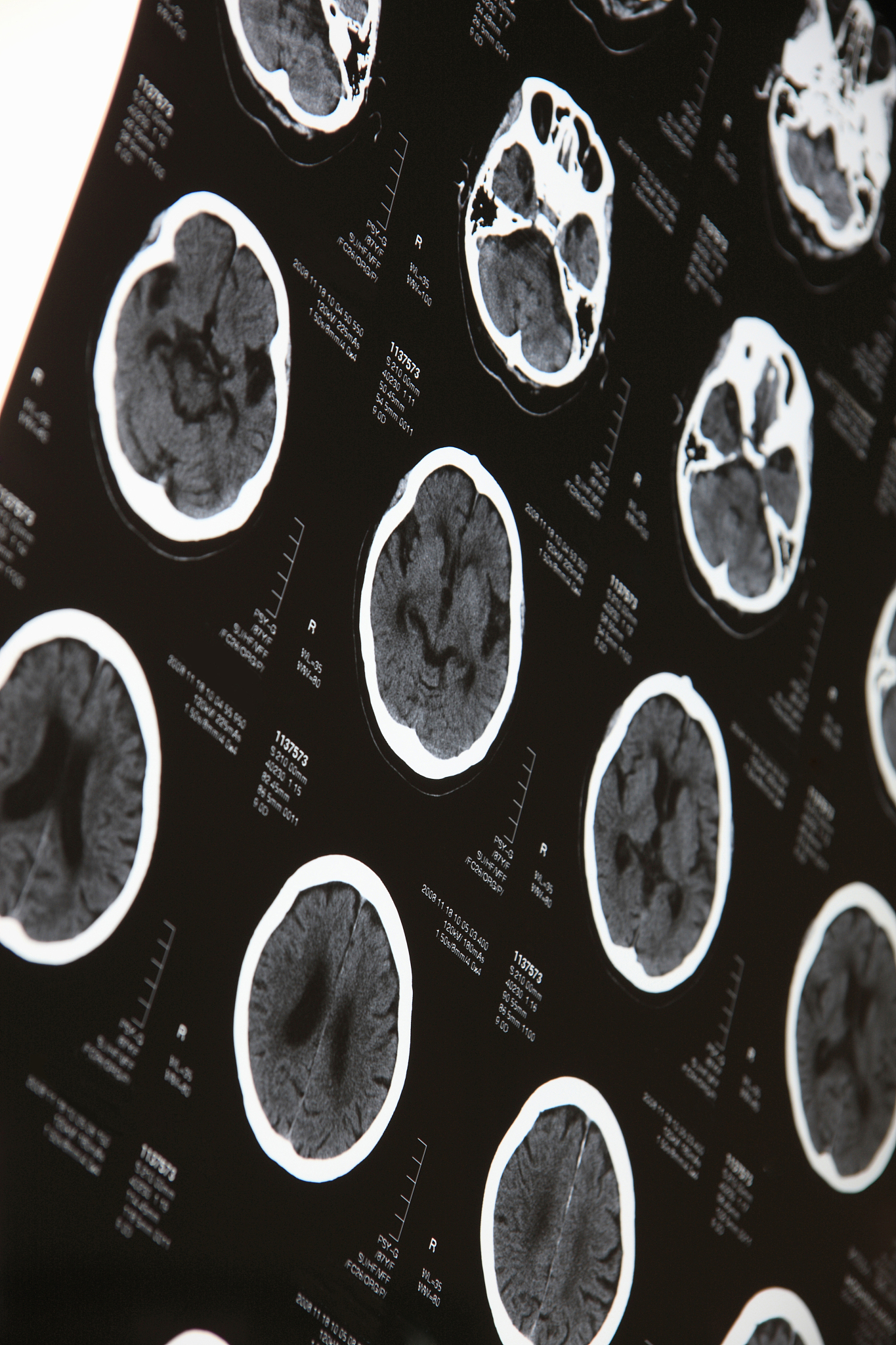 CT扫描的缺点：辐射风险、适用范围限制等