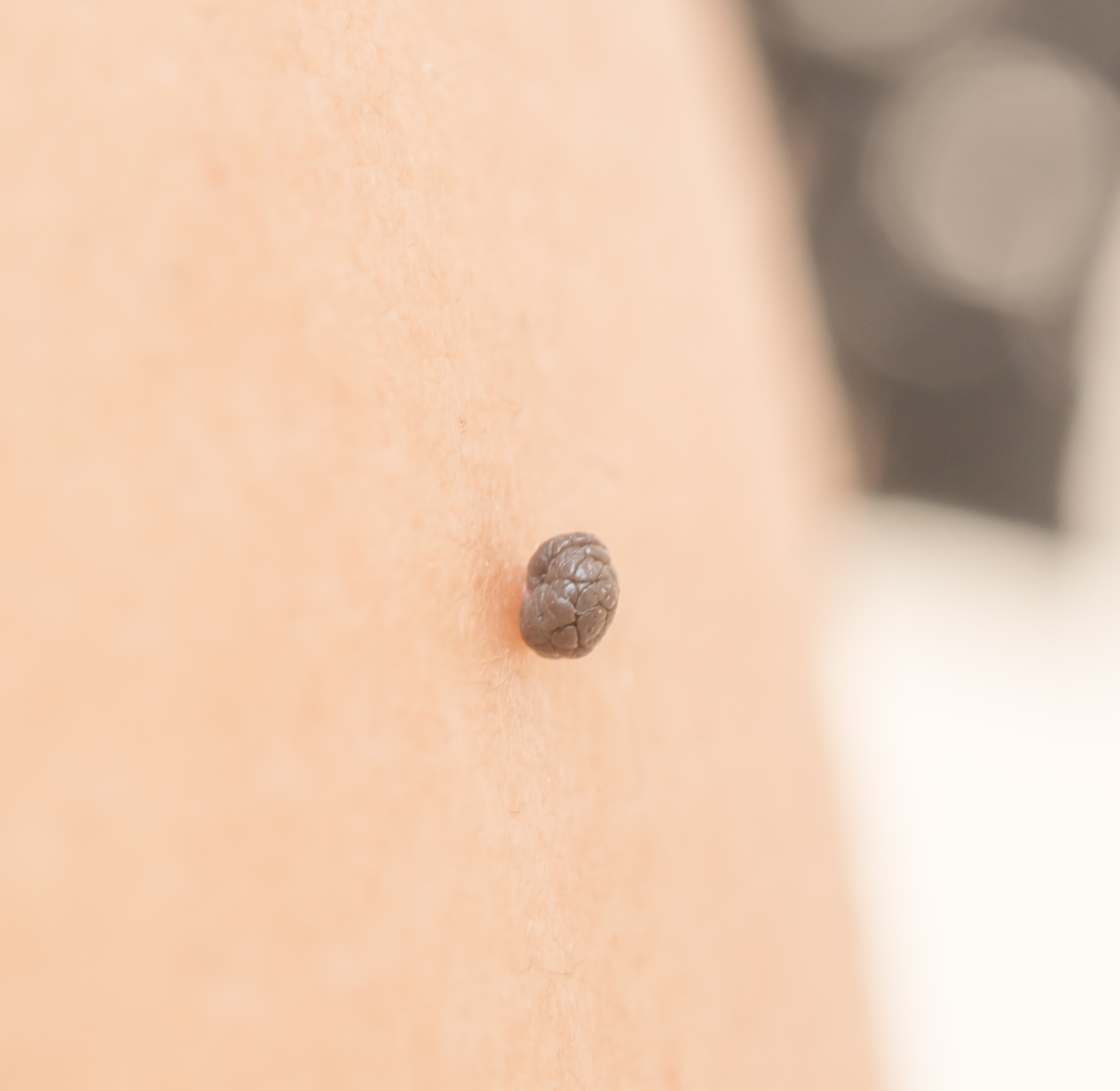 a lump on the skin