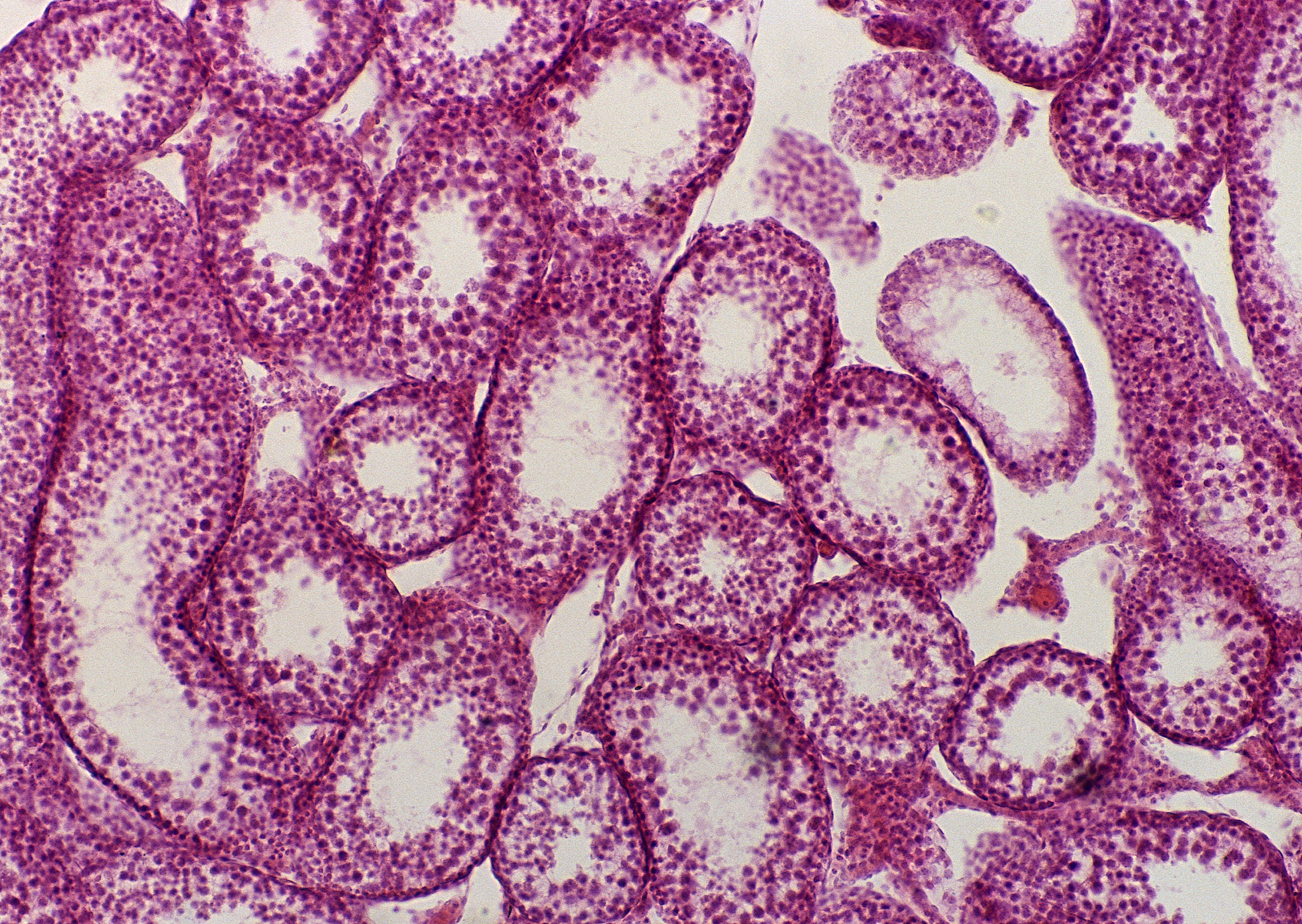 如何对乳腺癌的转移性进行预测