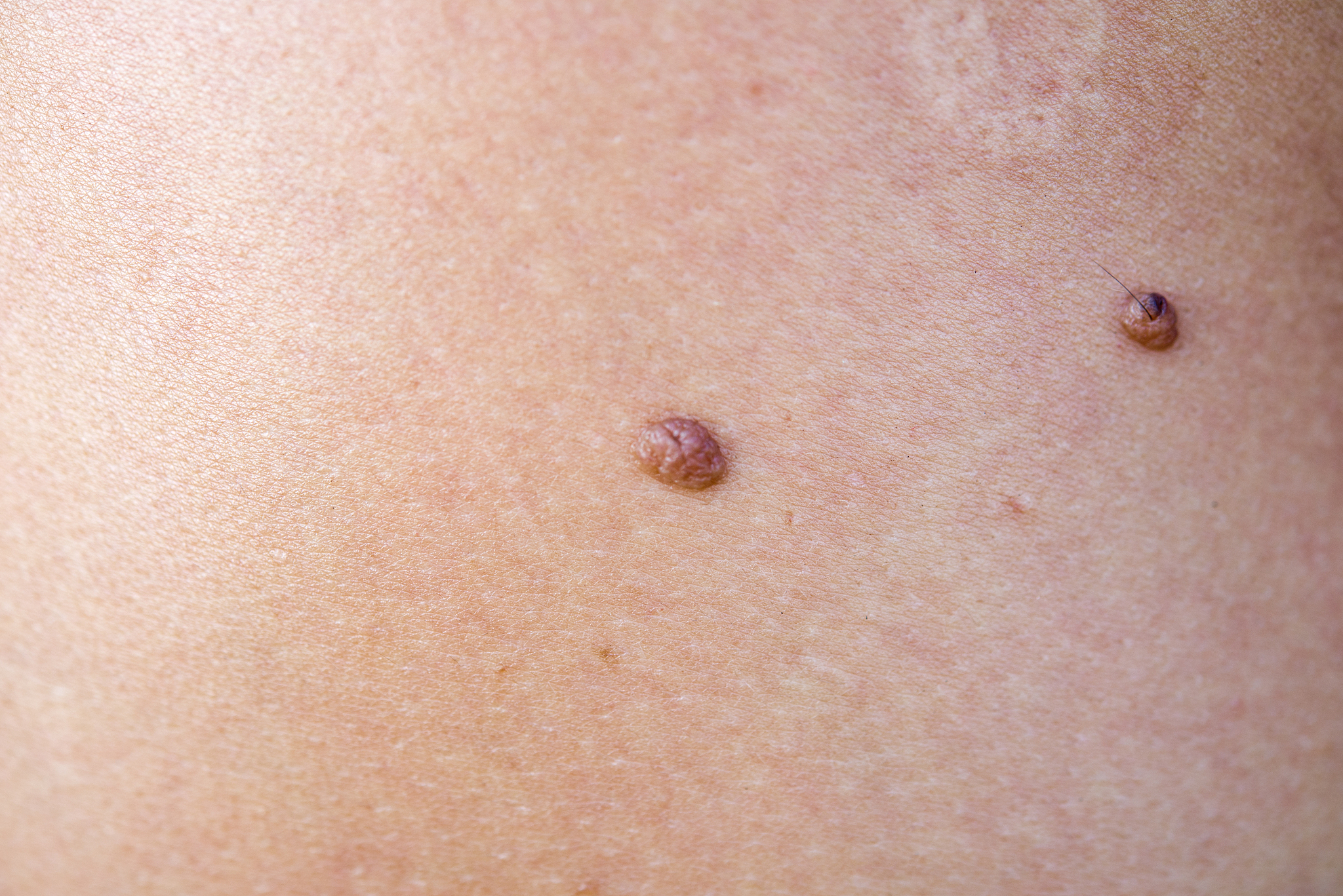 moles