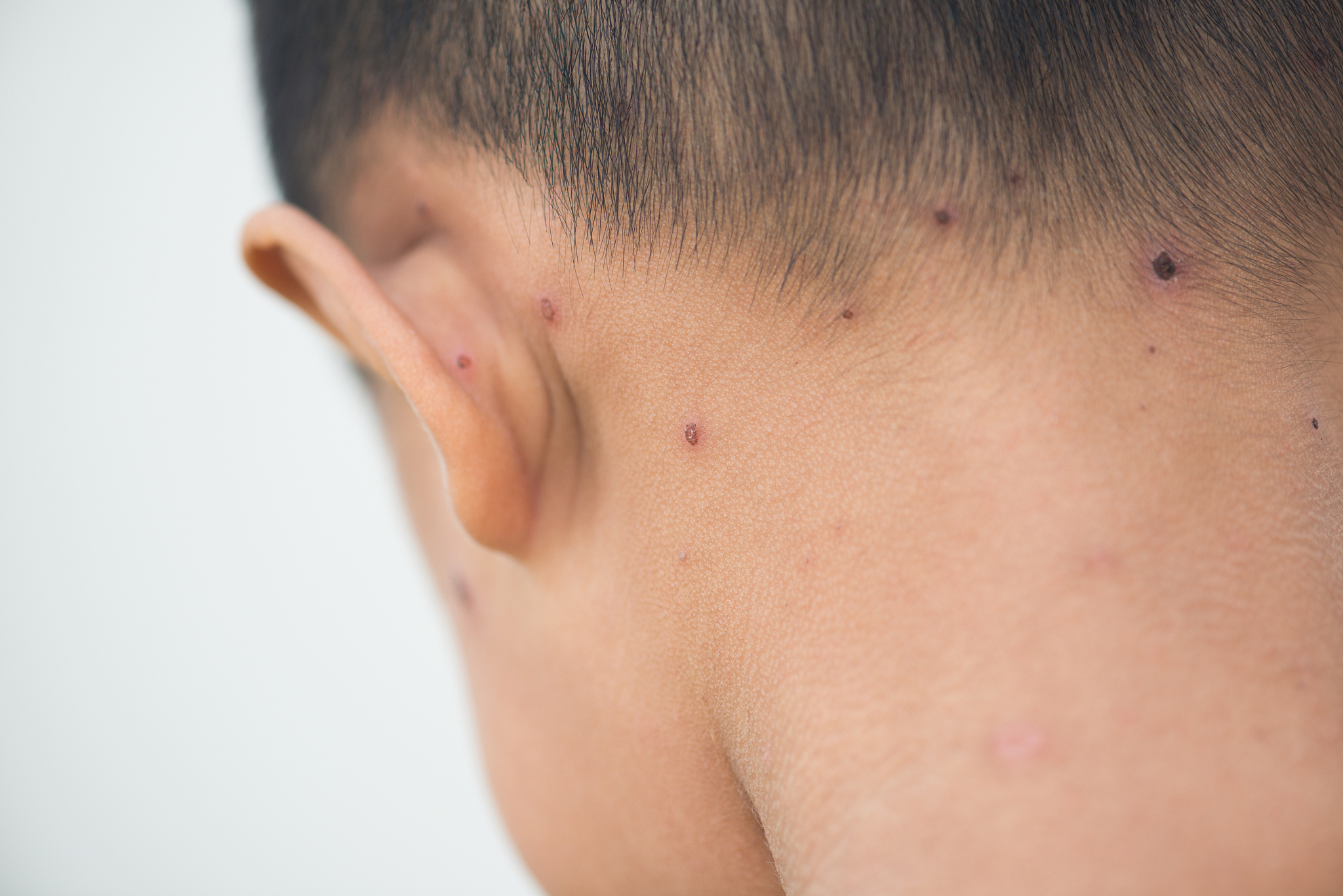 close-up of boy head with smallpox