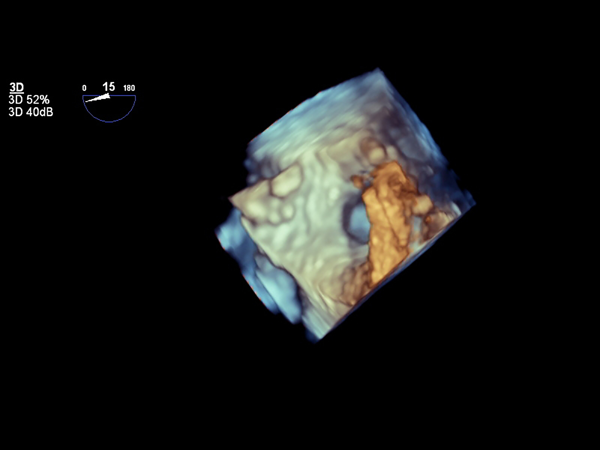 DSA: The Gold Standard for Carotid Artery Disease Diagnosis, But Not Without Drawbacks