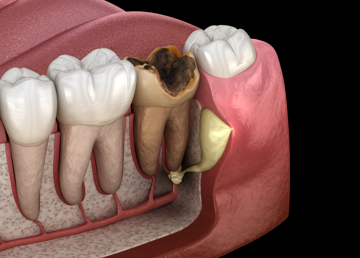 种牙有什么副作用