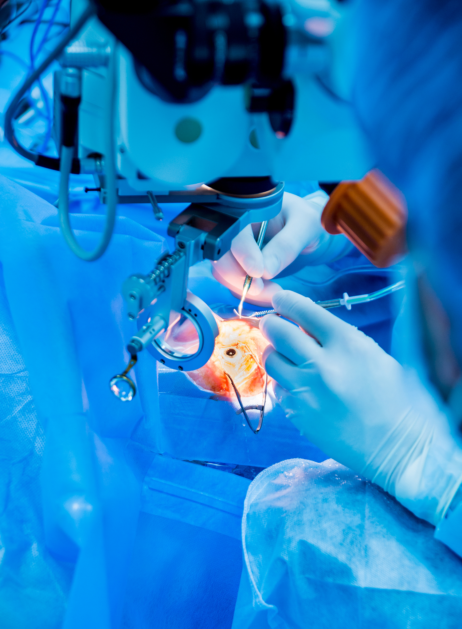 人工晶状体：生物材料与眼科手术的完美结合