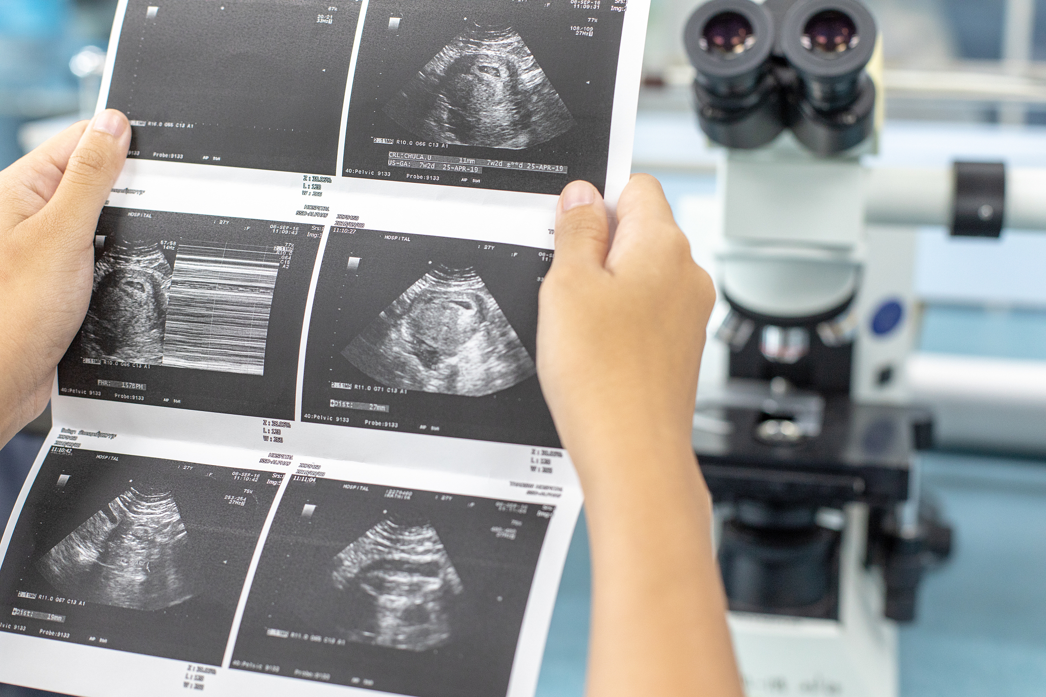 超声微血管成像技术评估女童中枢性性早熟：诊断价值及微血管灌注指标分析