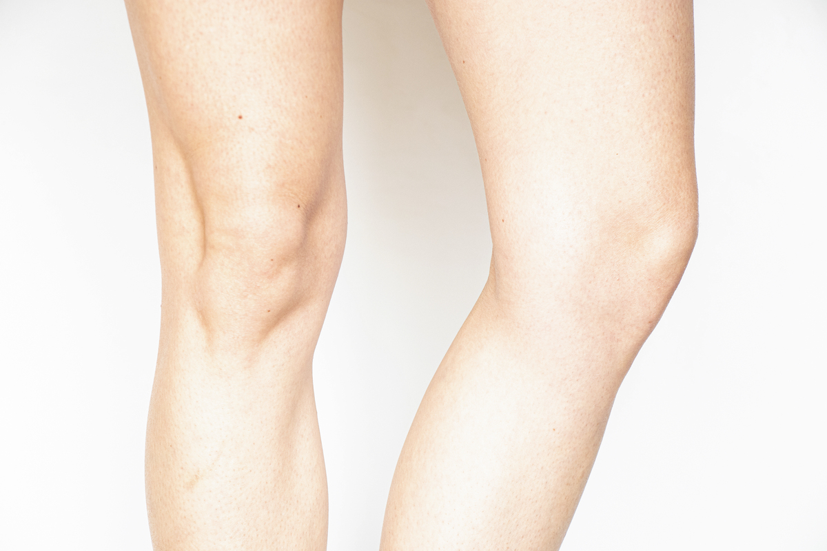 小腿突然变胖？可能是这些原因！