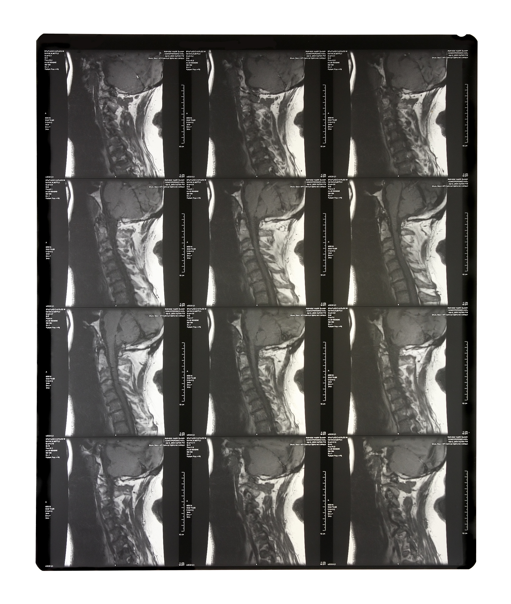 增强CT与增强MRI对颈动脉斑块新生血管评估及斑块稳定性预测的比较