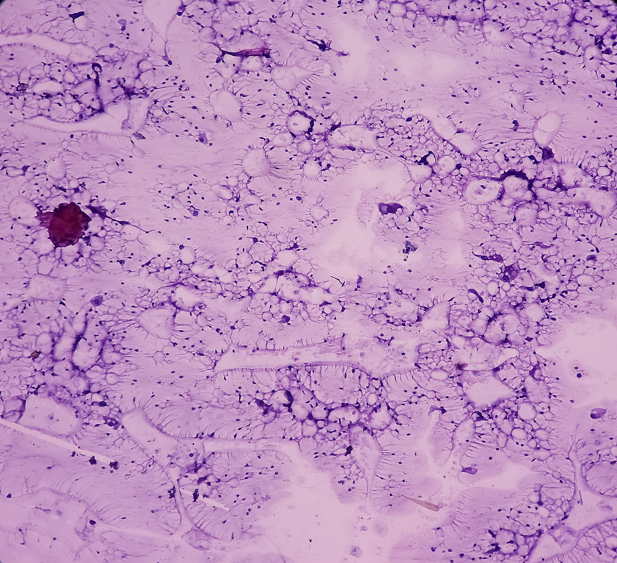 乳腺超声图片相关介绍