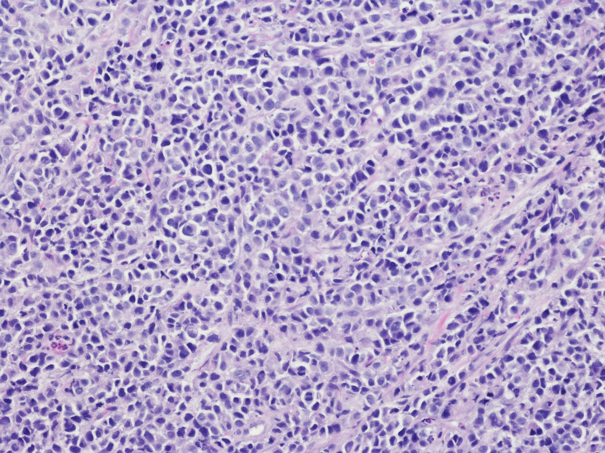 食管癌并发食管胃支气管瘘怎么吃？饮食护理指南