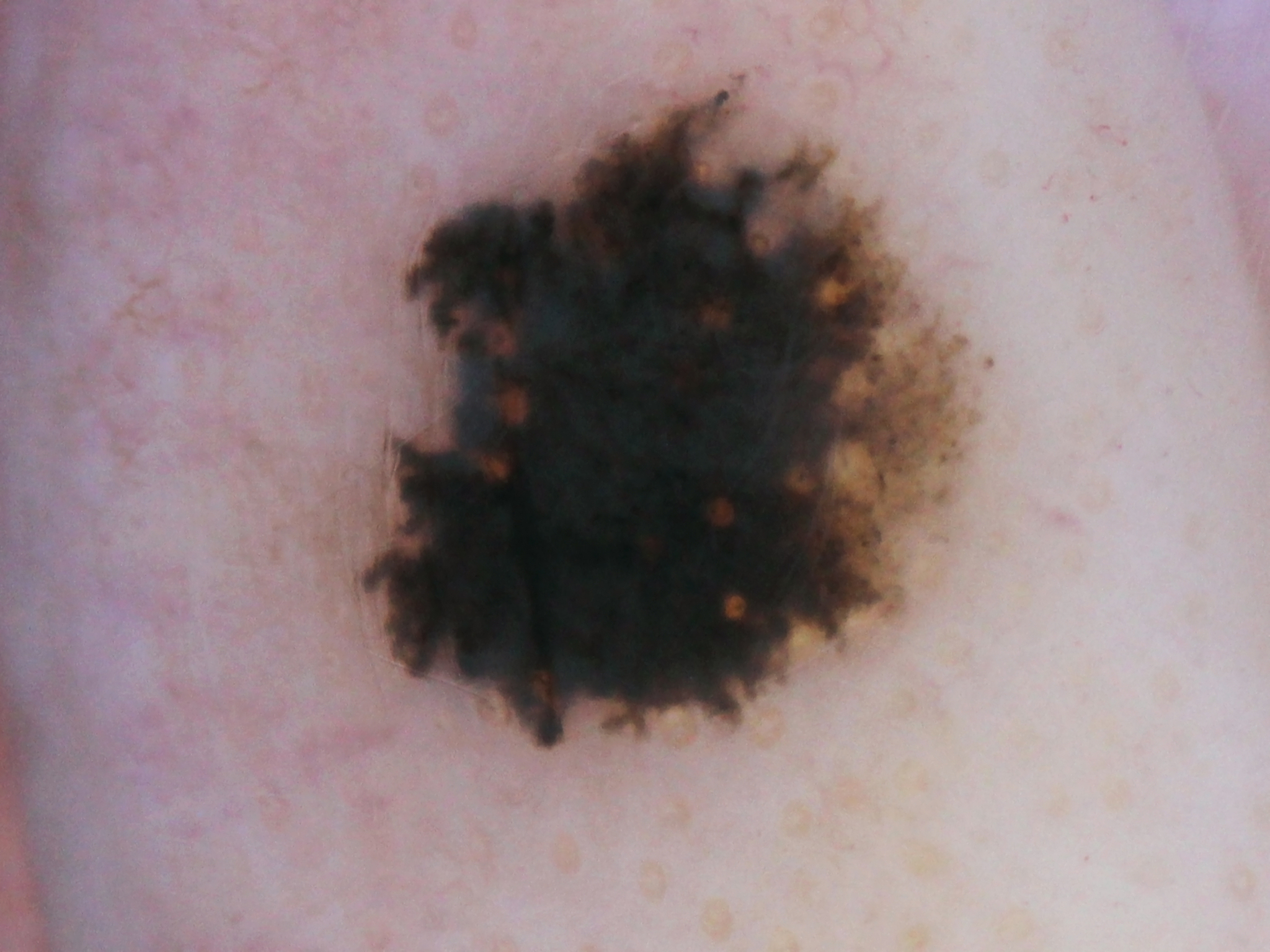 melanoma - a malignant tumor of the human skin