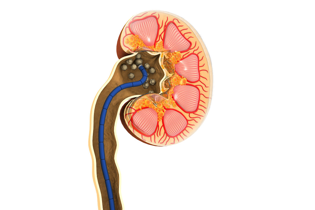 输尿管结石合并右肾积水怎么办？治疗方法与预防措施