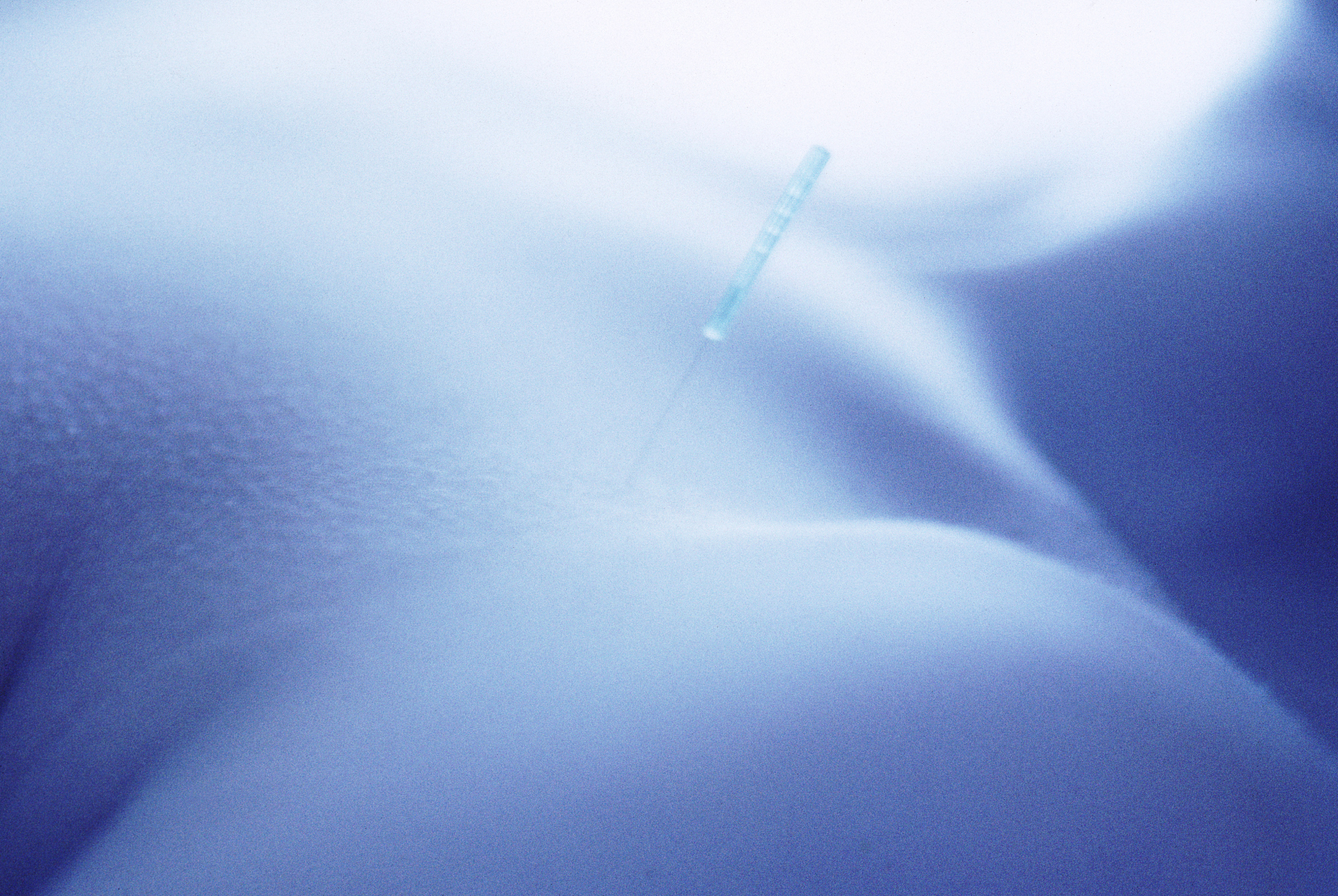 acupuncture needle