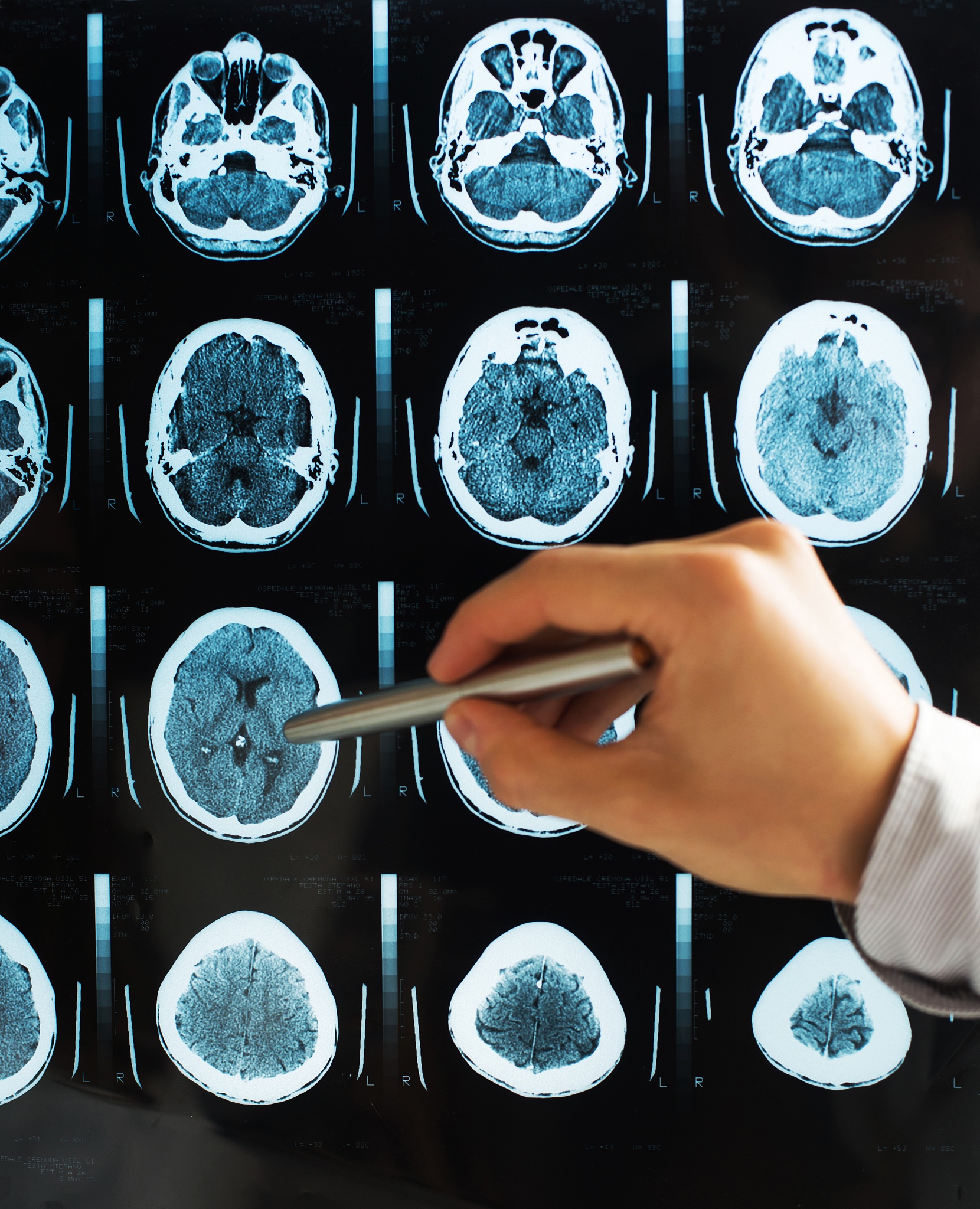 Please help me translate the following Chinese into English：图像配准精度验证分别利用脊柱模型与两名患者的CT医学图像与x光图像进行了2D3D配准实验。对脊柱模型绕z轴顺时针旋转脊柱x光图像十度重复进行10组配准实验。在两名患者的医学图像进行了配准实验。