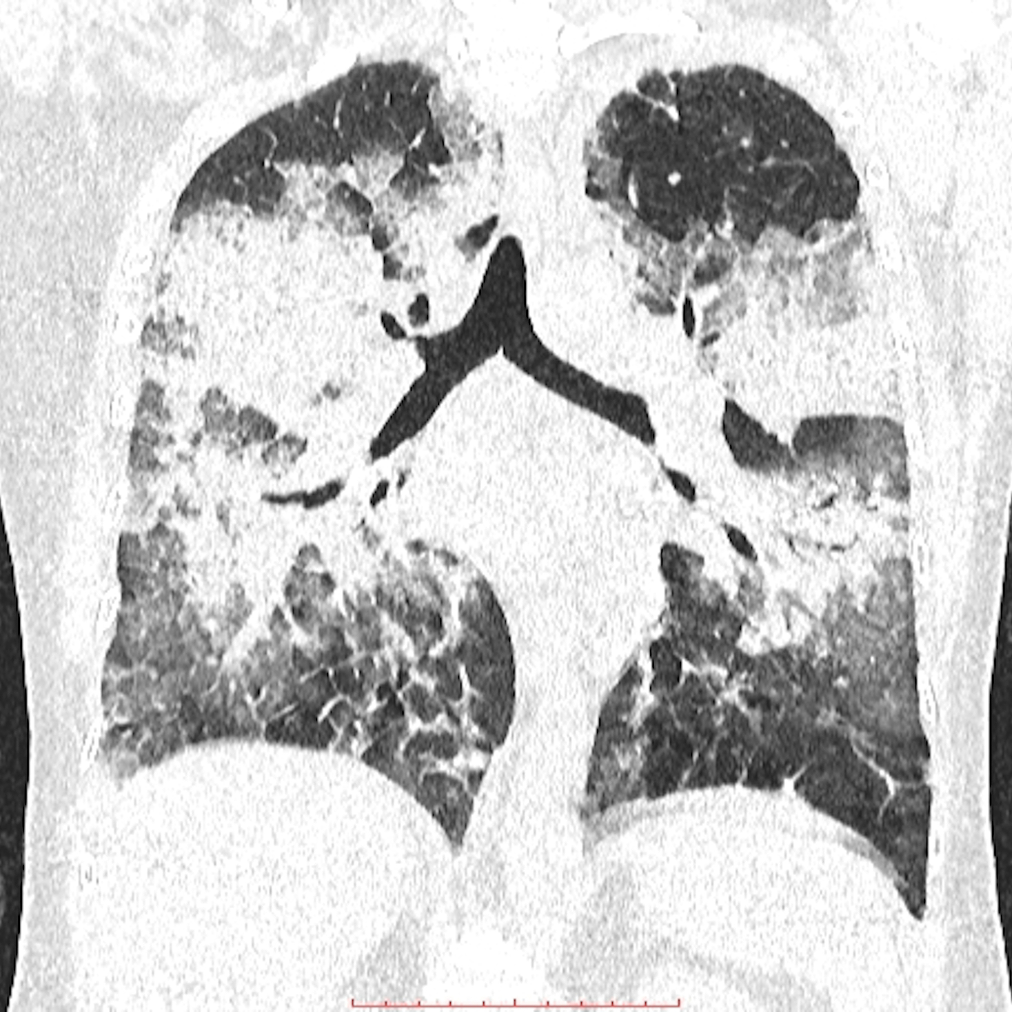 介绍一下胸膜间皮瘤，以标准的综述论文的形式书写，先输出文章的章节主题