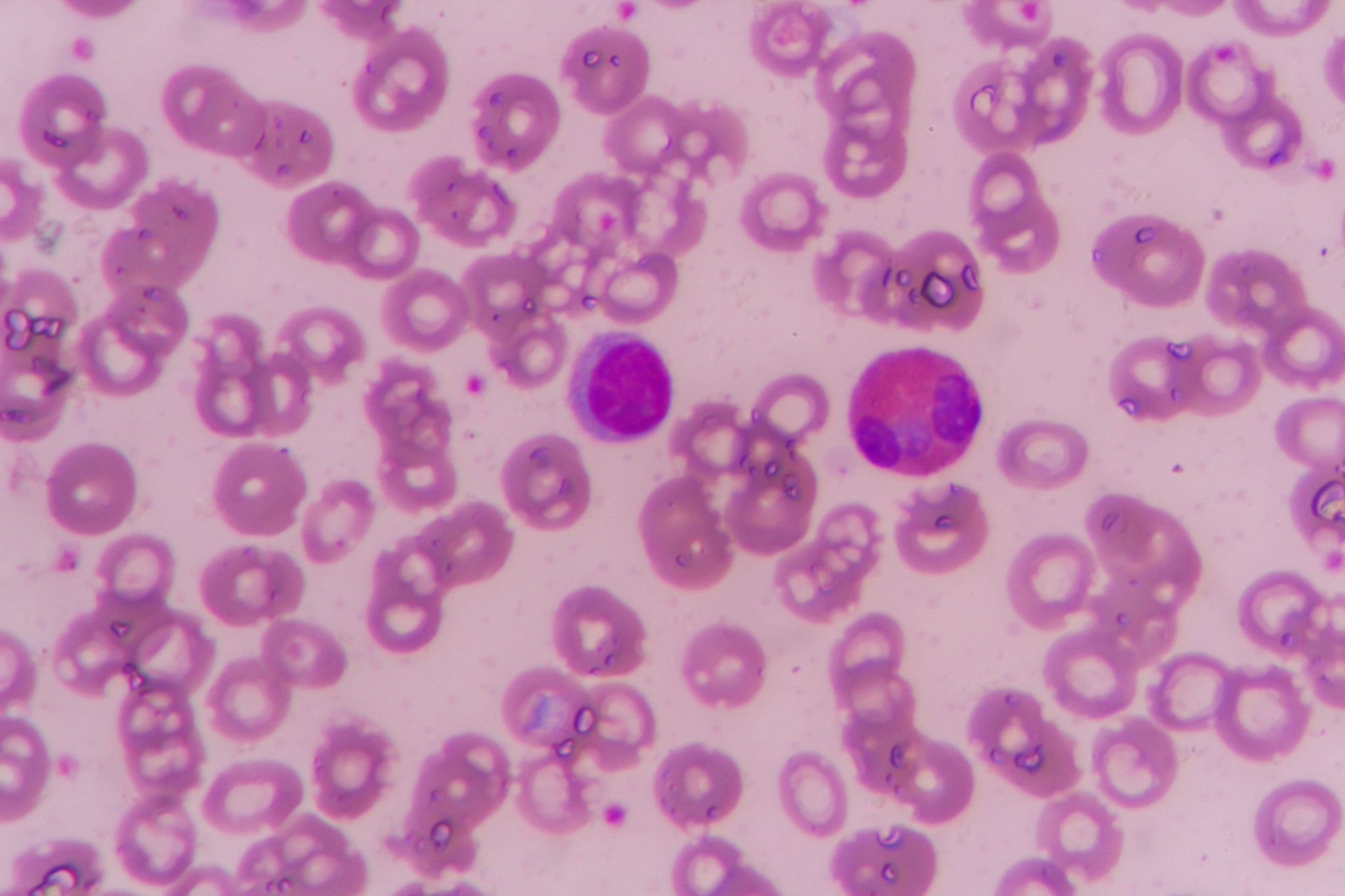 嗜碱性粒细胞白血病和肥大细胞白血病怎么鉴别诊断？