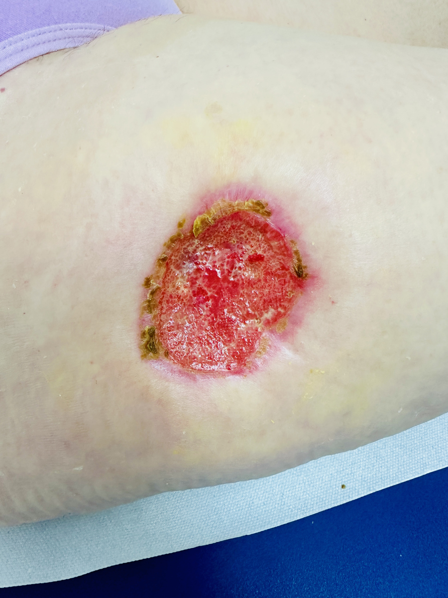 硬结型疤痕疙瘩治疗方法：手术、注射、激光、物理疗法