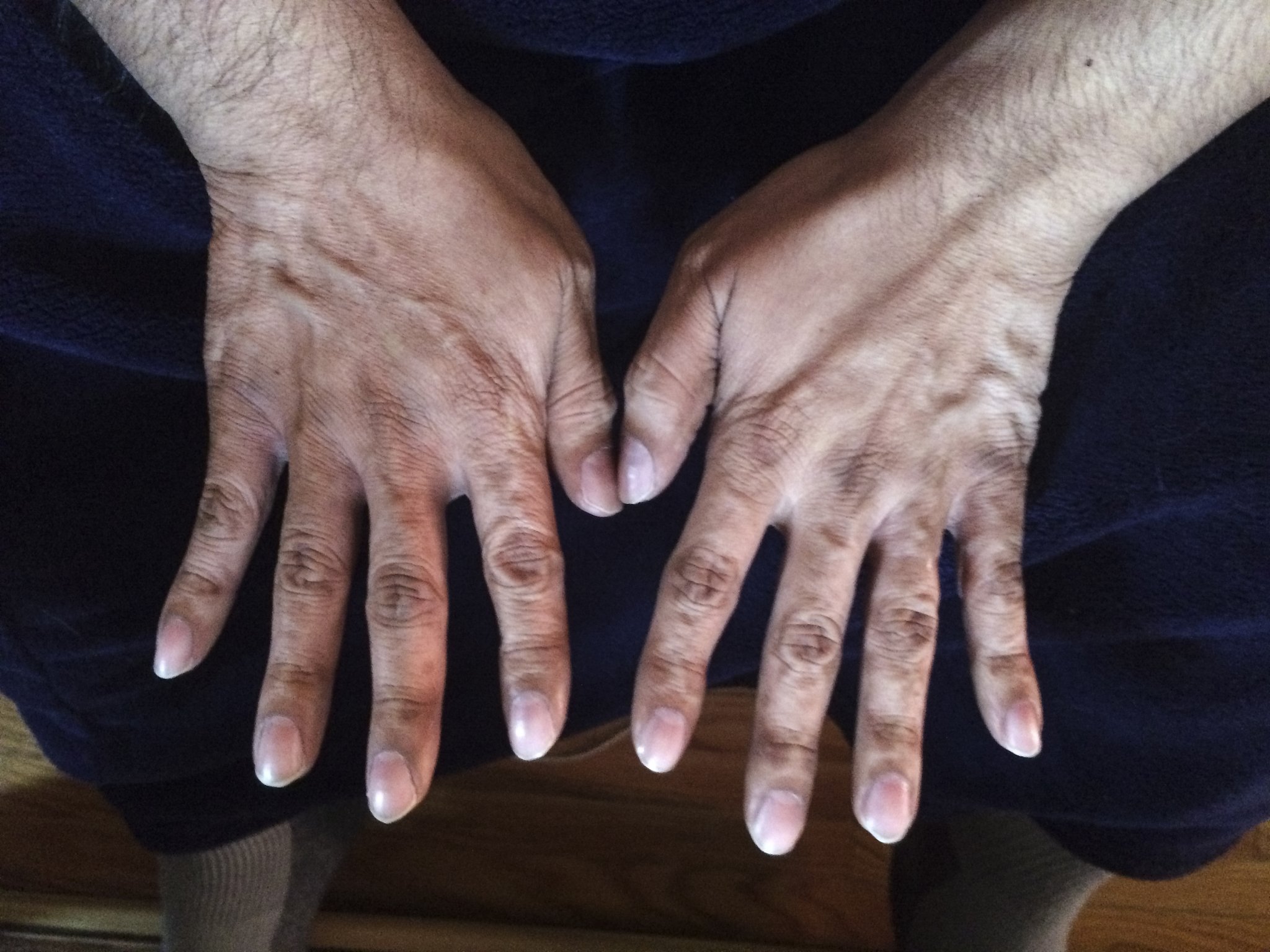 肝脏囊性转移瘤