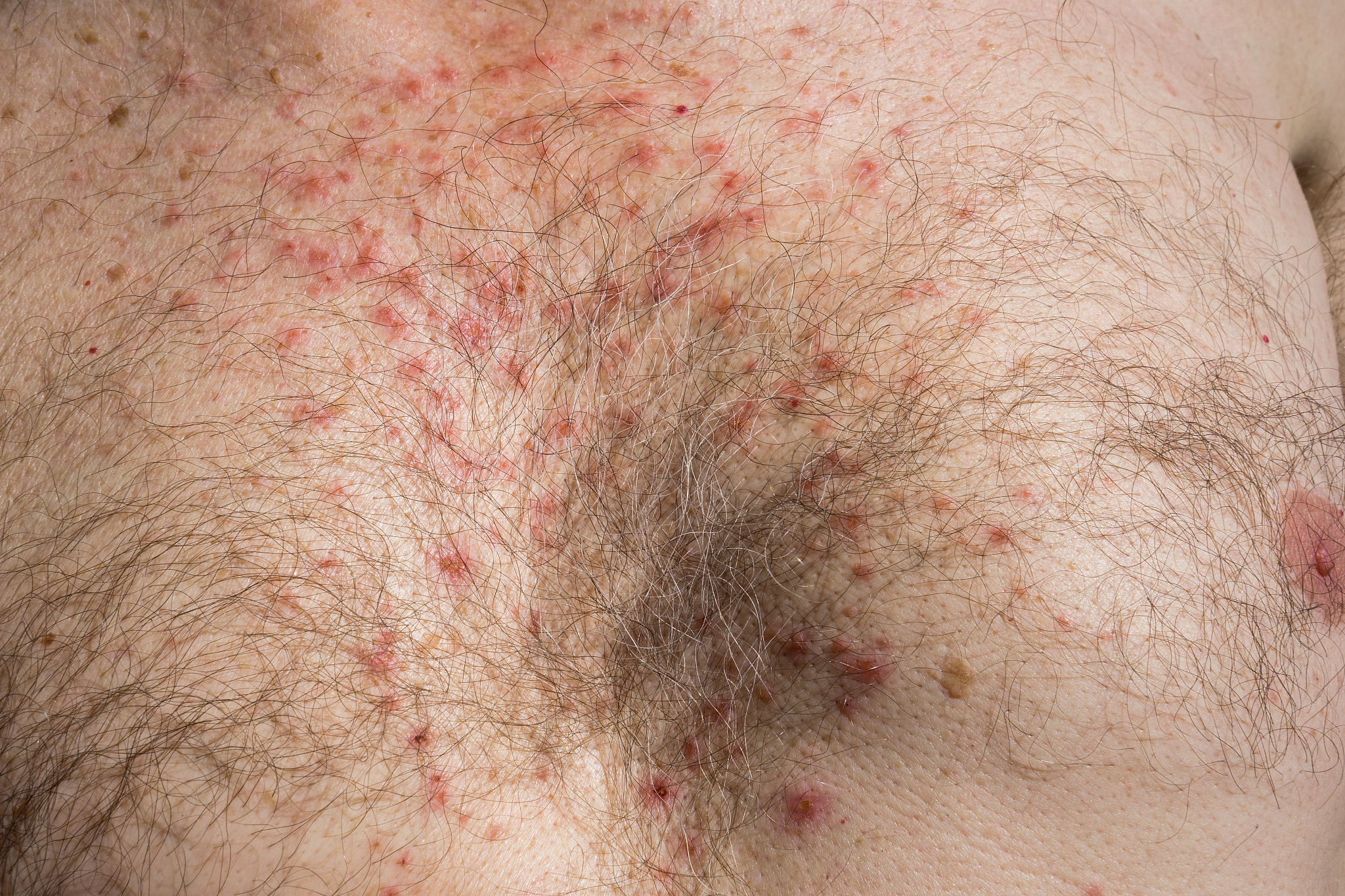 chest skin rash as drug side effect after surgery