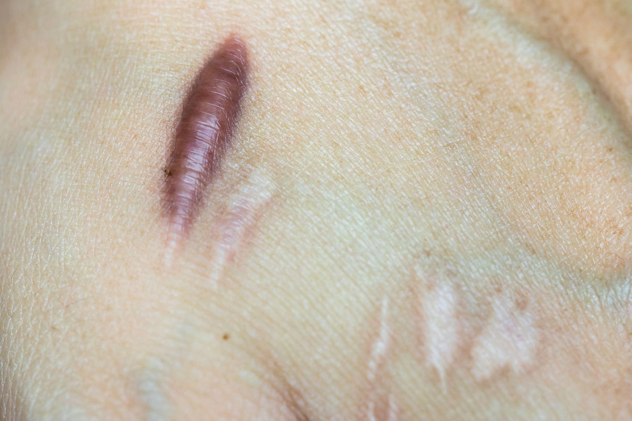 伤口好了后皮肤疤痕皮肤凸起