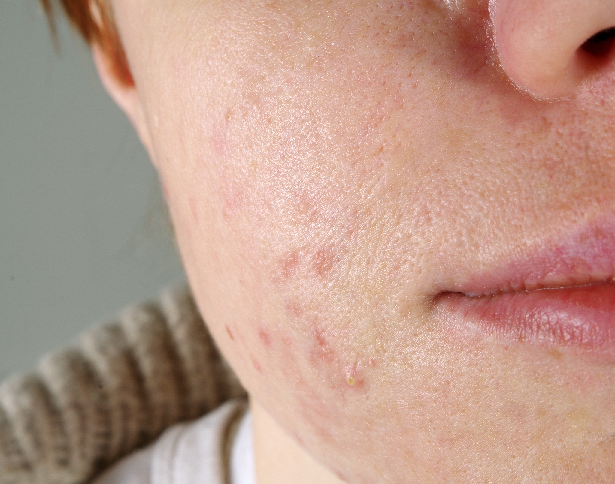 close-up of woman face with pimples