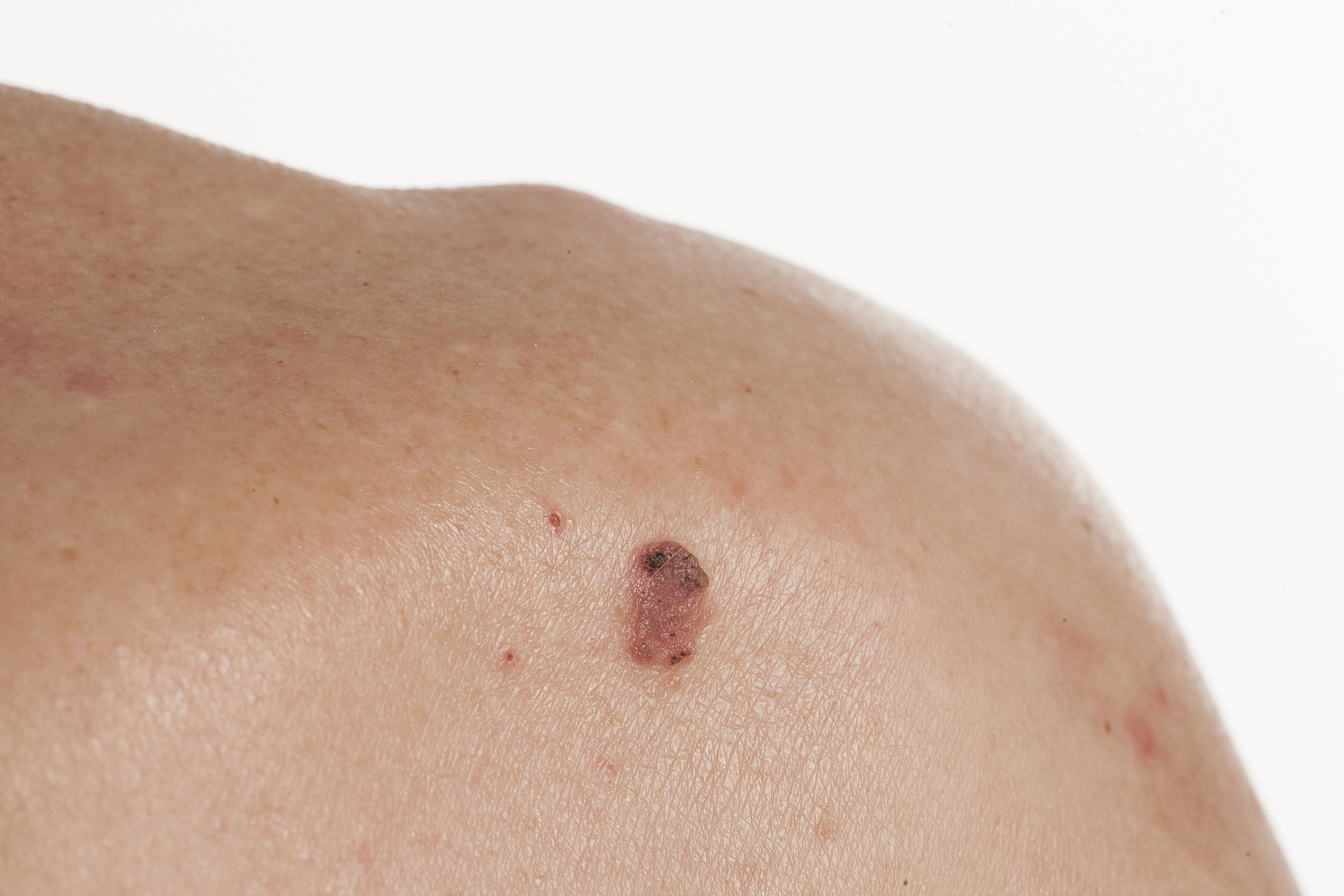 keratinizing squamous cell carcinoma of the skin