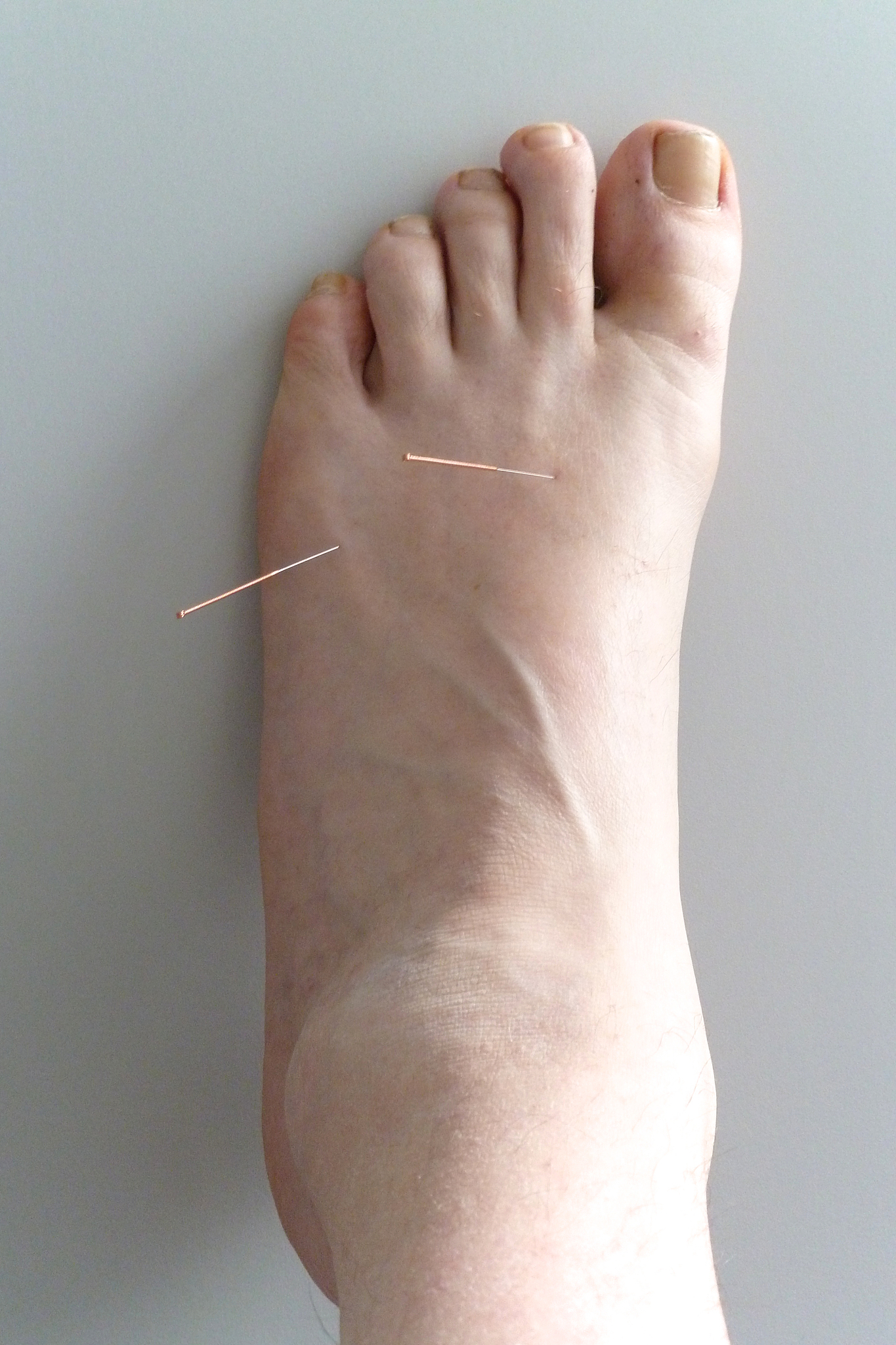 close-up of person with acupuncture needles