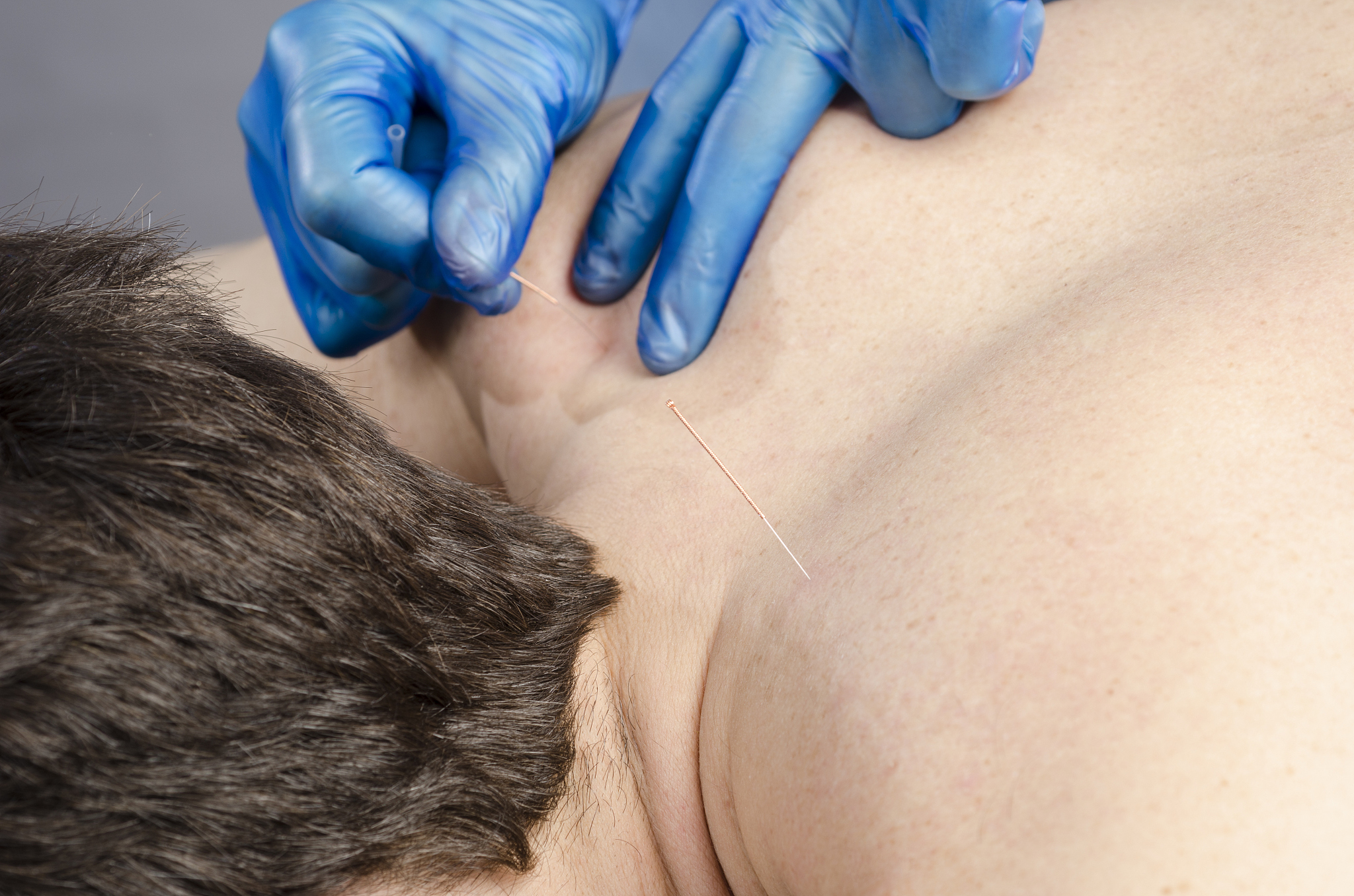 重庆针灸卫校：专业针灸人才培养基地