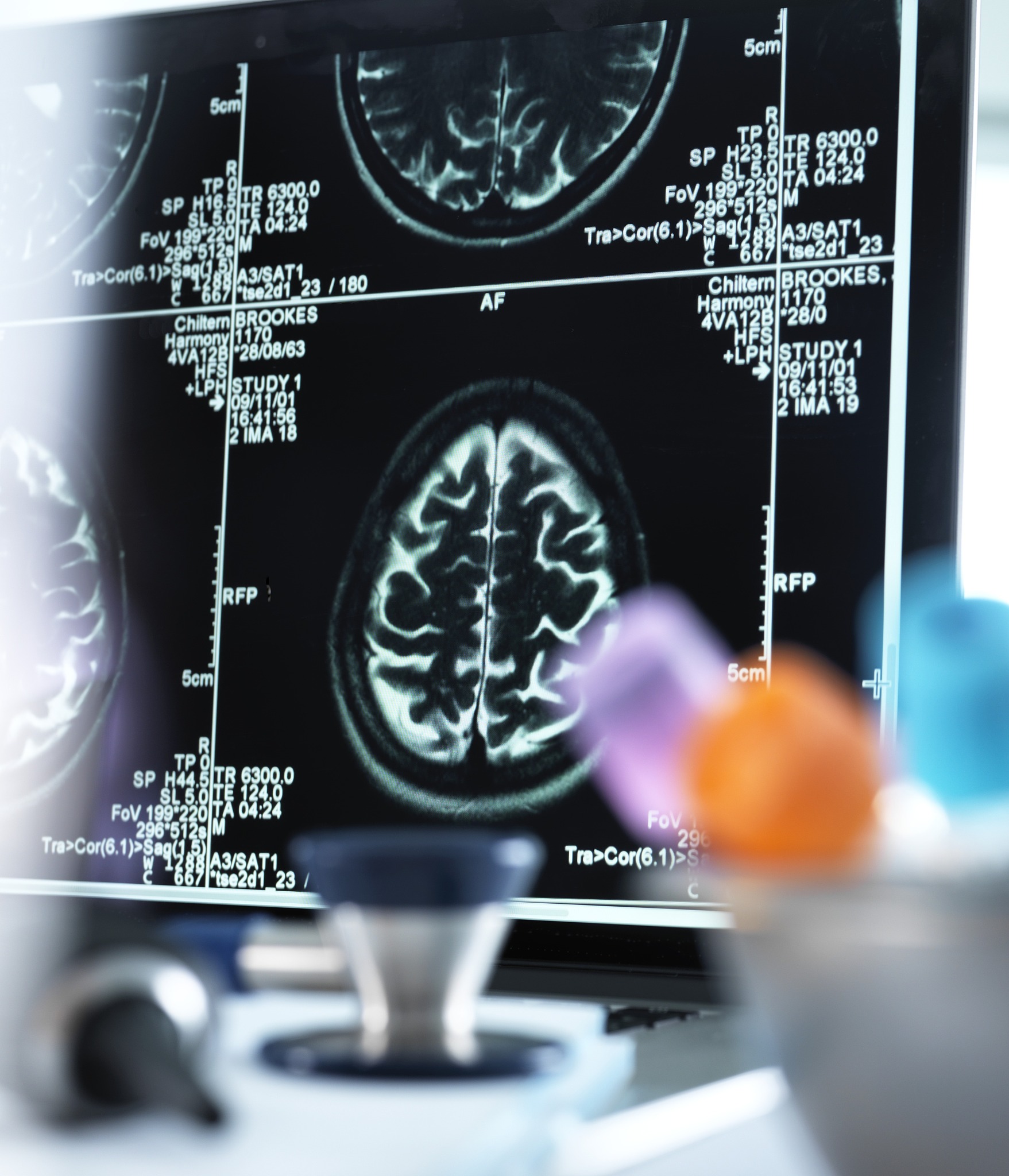 快速识别中风病因的影像学技术：意义重大