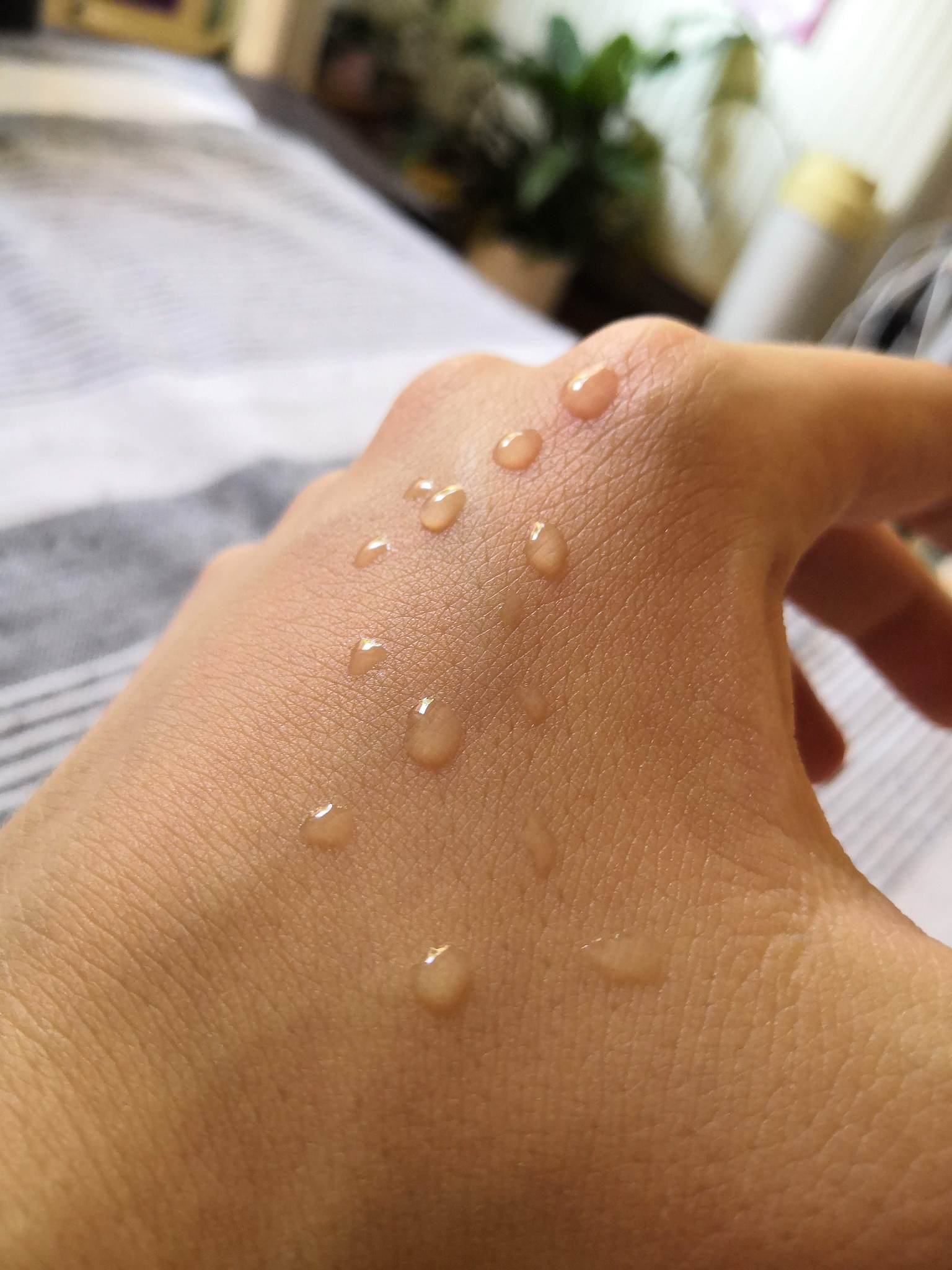 怎么快速治疗汗疱疹