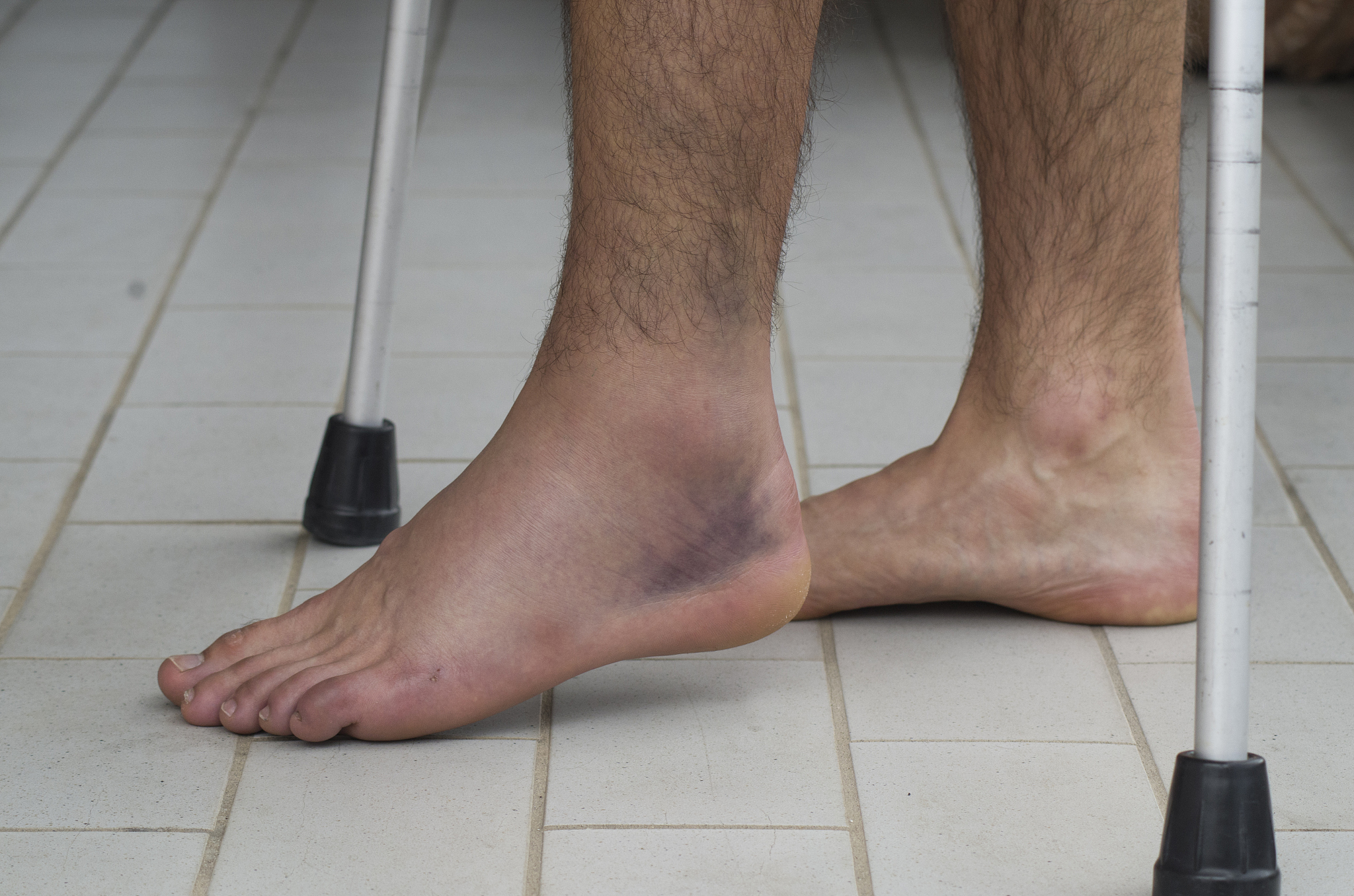 脚崴了肿最大是什么时候