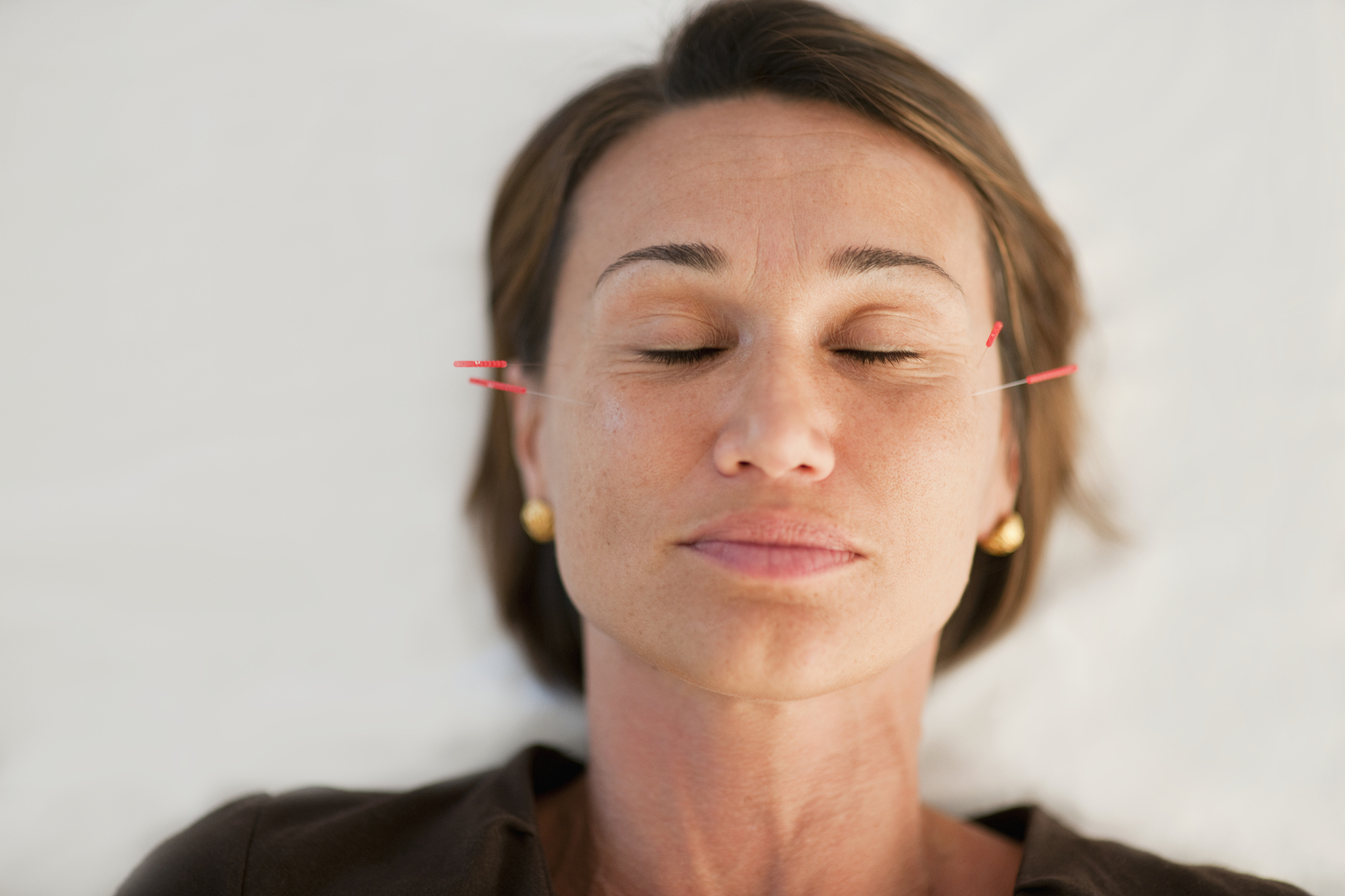 woman getting acupuncture