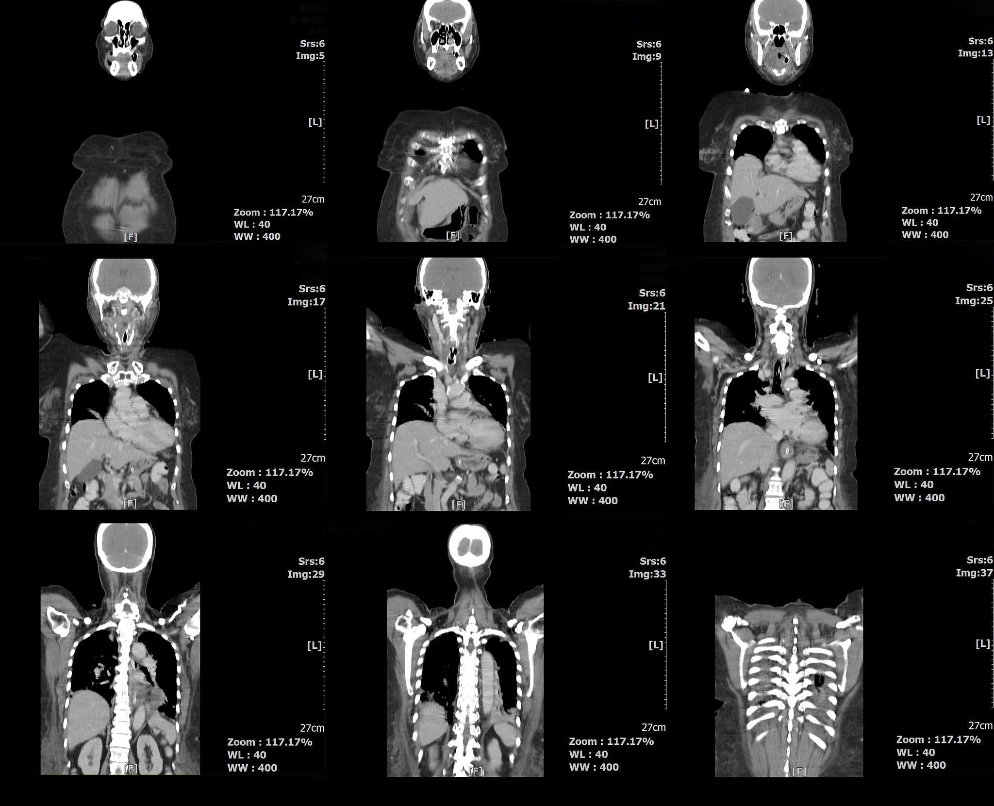 Dyna-CT Assisted Neuroendoscopic Hematoma Evacuation for Hypertensive Intracerebral Hemorrhage: A Review