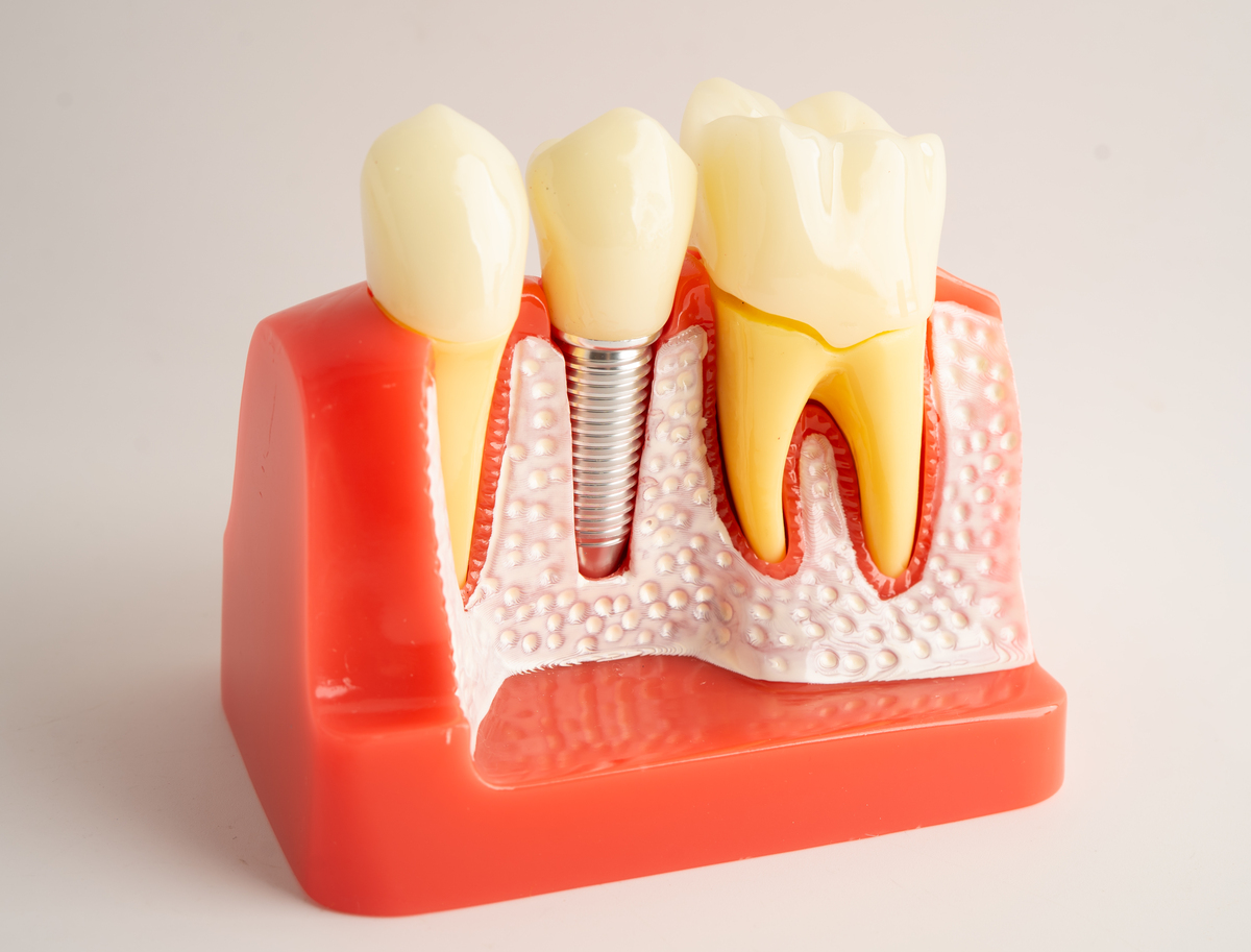 生物陶瓷类材料单尖法根管充填术