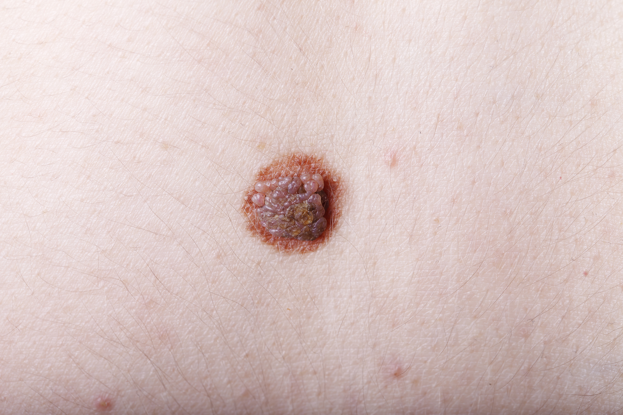 large mole, close-up, medicine, health