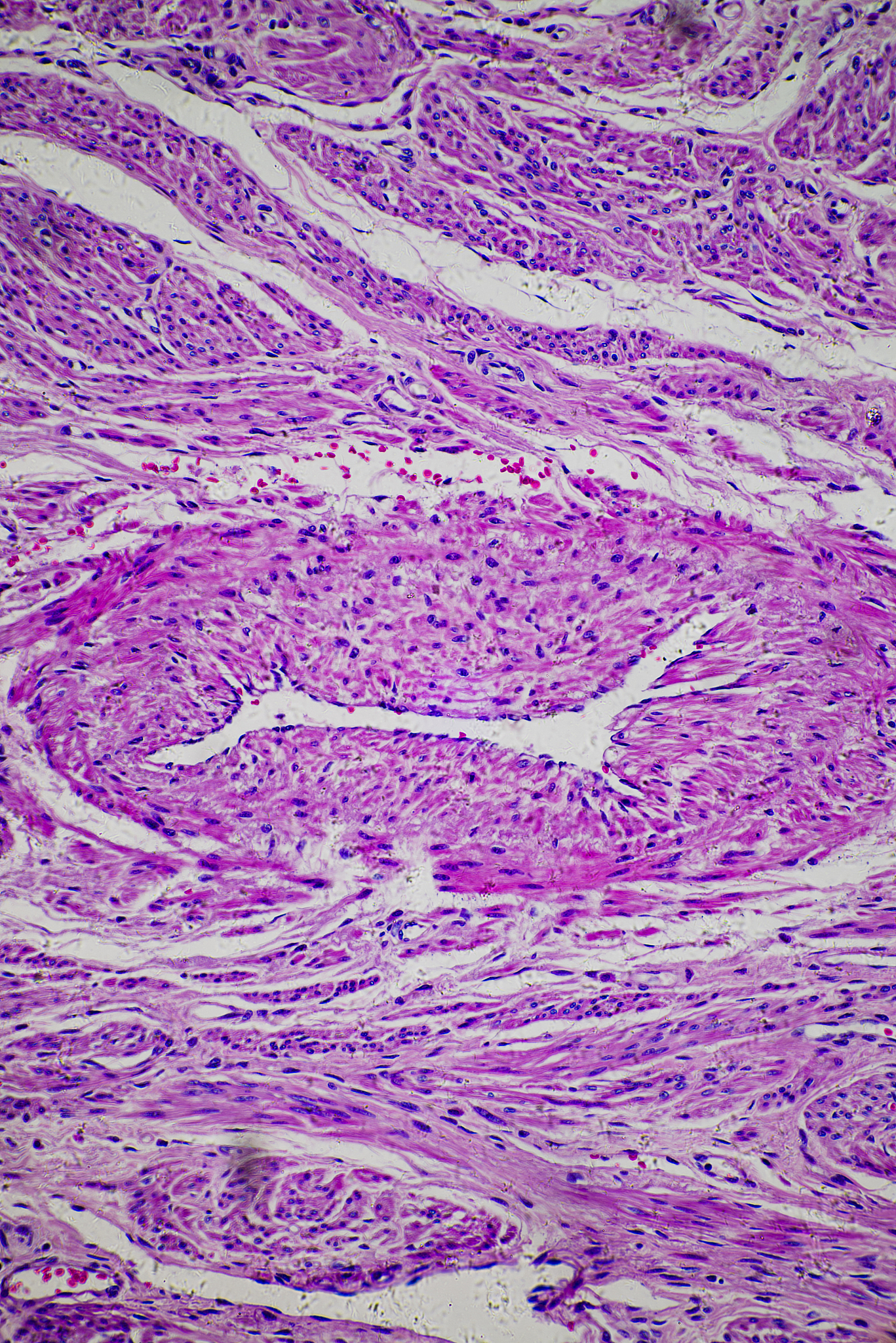 子宫肌瘤是什么？症状、治疗方法及预防 - 专业妇科指南