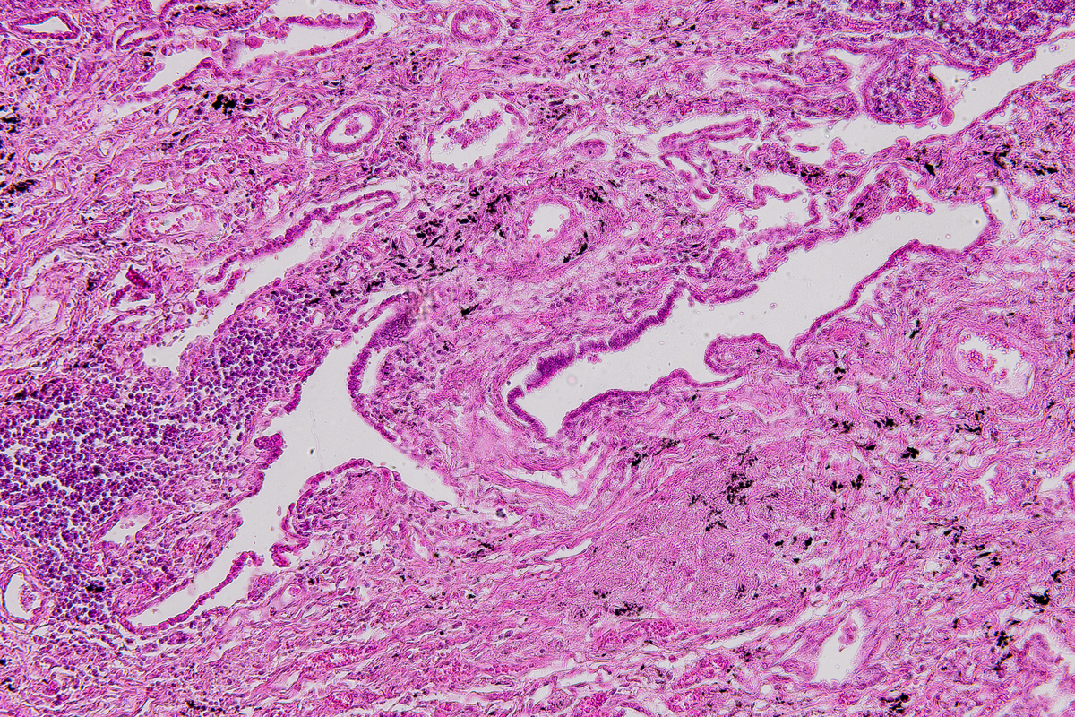 三阴性乳腺癌转移位置：了解淋巴结、肺、肝、骨和脑转移风险