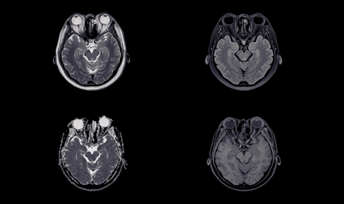 Right-Sided Lacunar Infarction in Caudate Nucleus: Correlation with Neurological and Psychiatric Symptoms