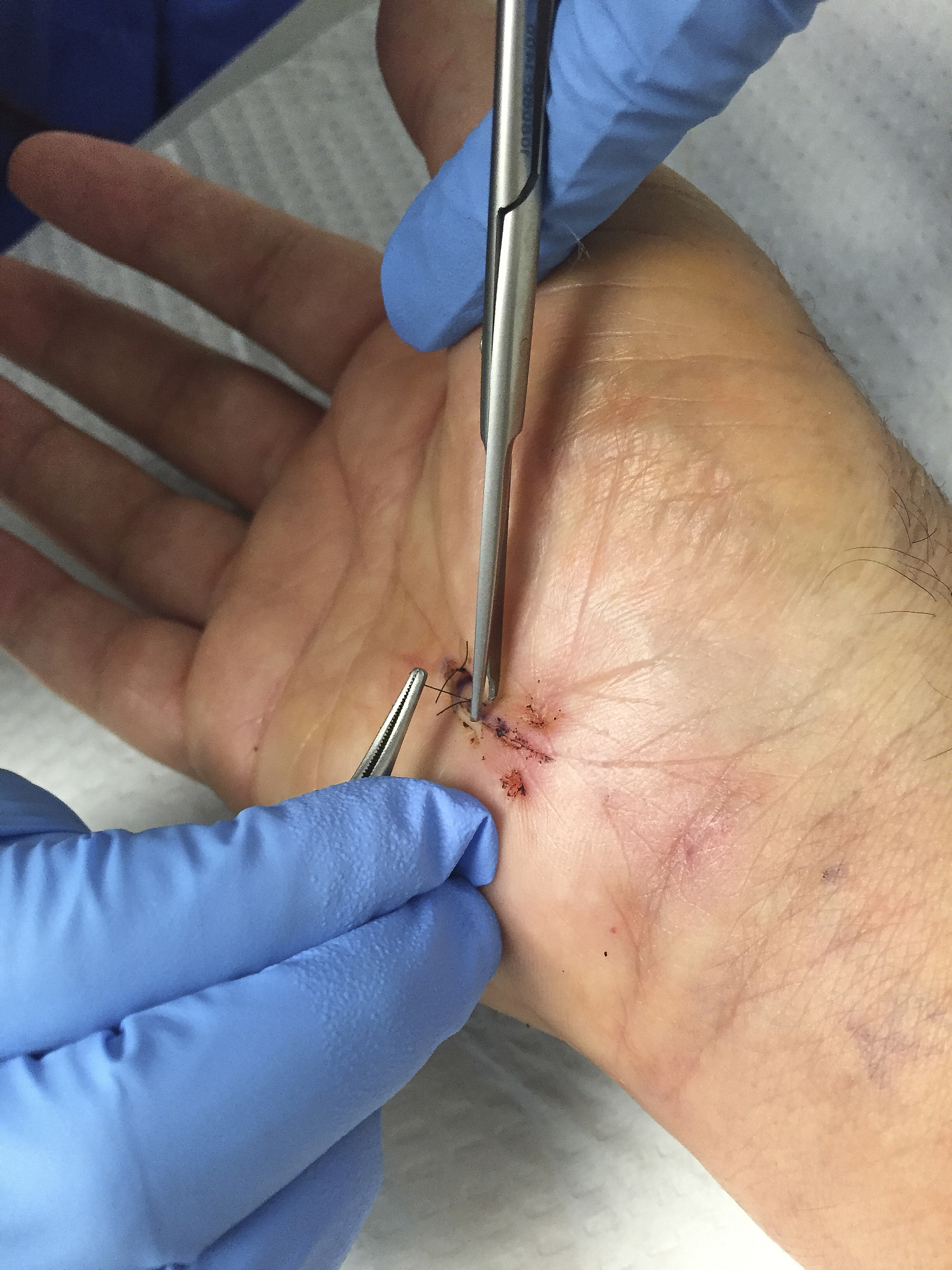 阑尾炎微创刀口缝线拆除