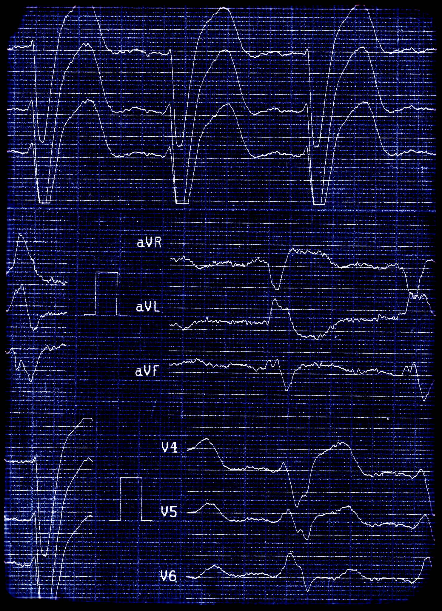 心率显示电路采用共阳极八段数码管