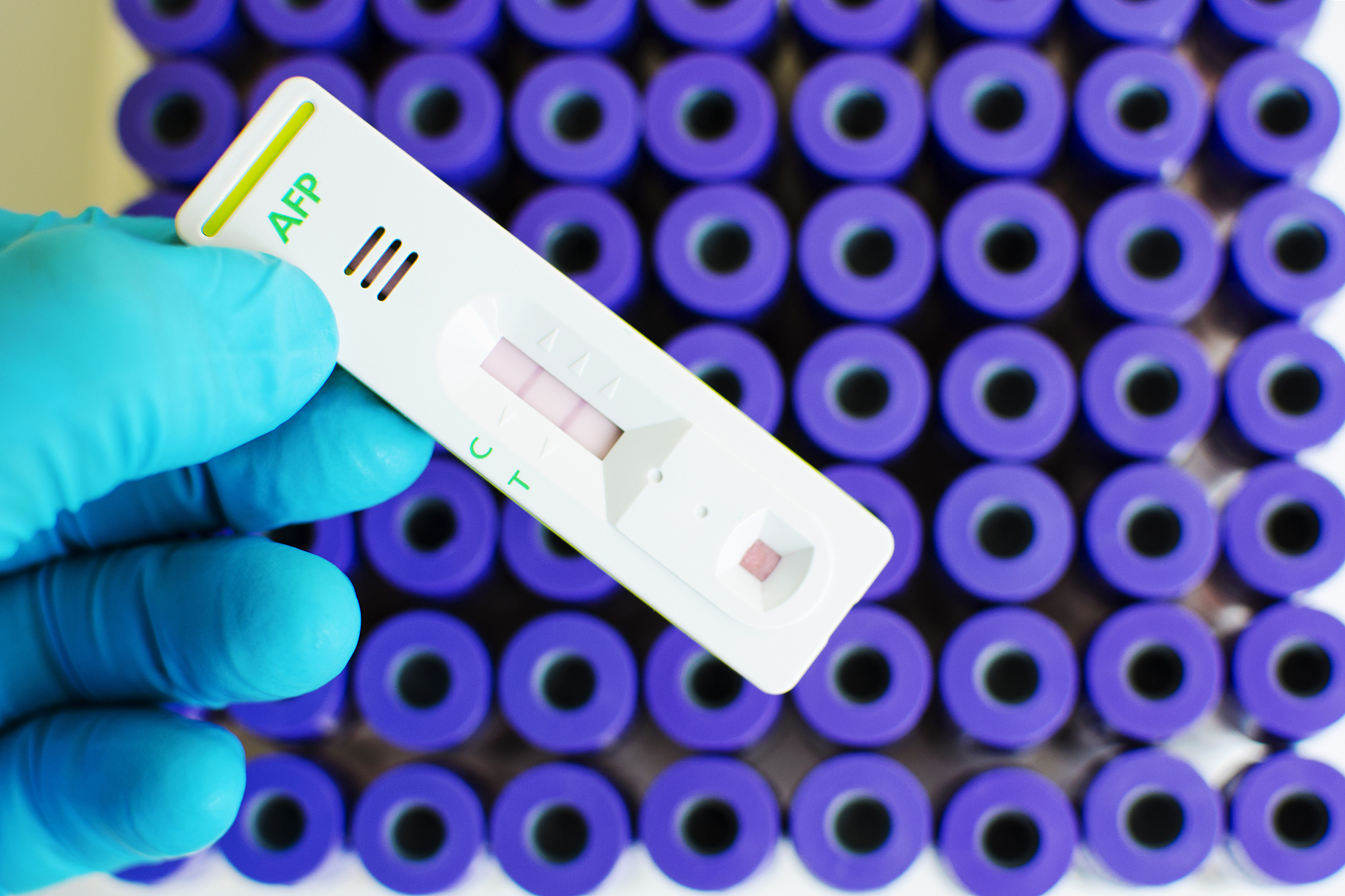 血清 AFP、AFP-L3 和 PIVKA-Ⅱ 表达水平与原发性肝癌患者肝切除术后早期预后的关系