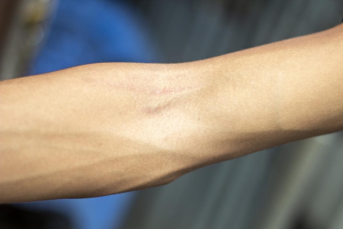 手上白斑的原因和区别：从白癜风到无色素痣