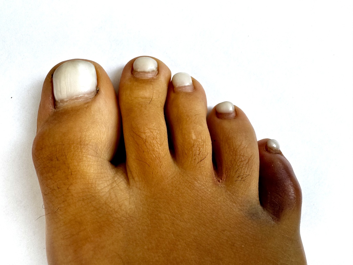 大脚趾弯曲疼痛的原因及治疗方法 - 常见问题解答