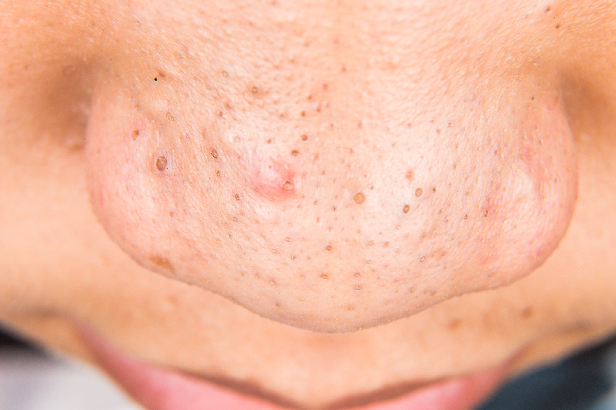 ugly pimples, acne, zit, blackheads on the nose of teenager