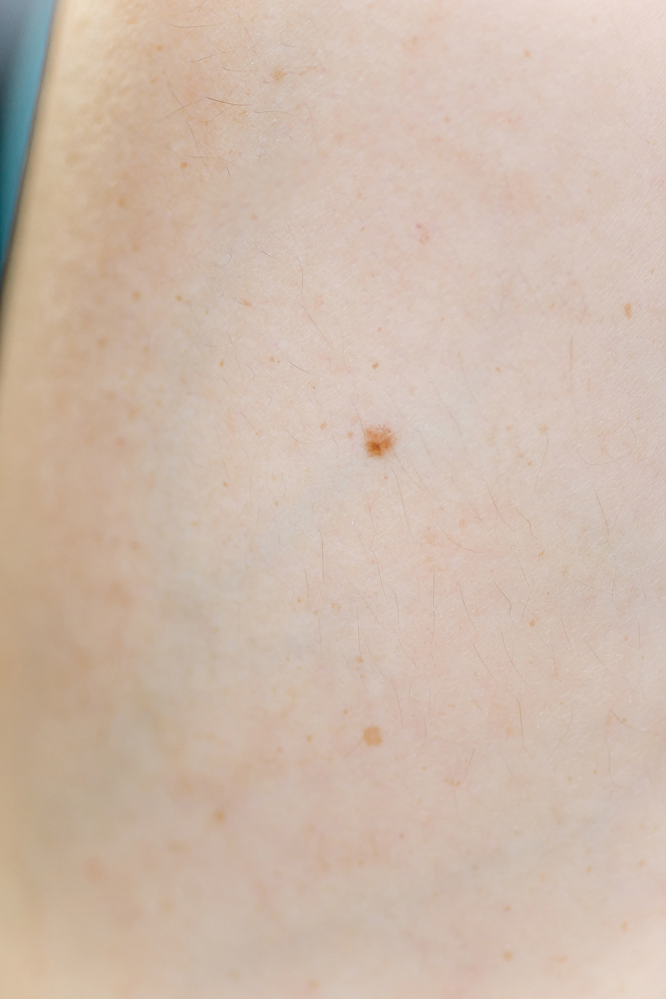 a birthmark or a mole on a woman skin