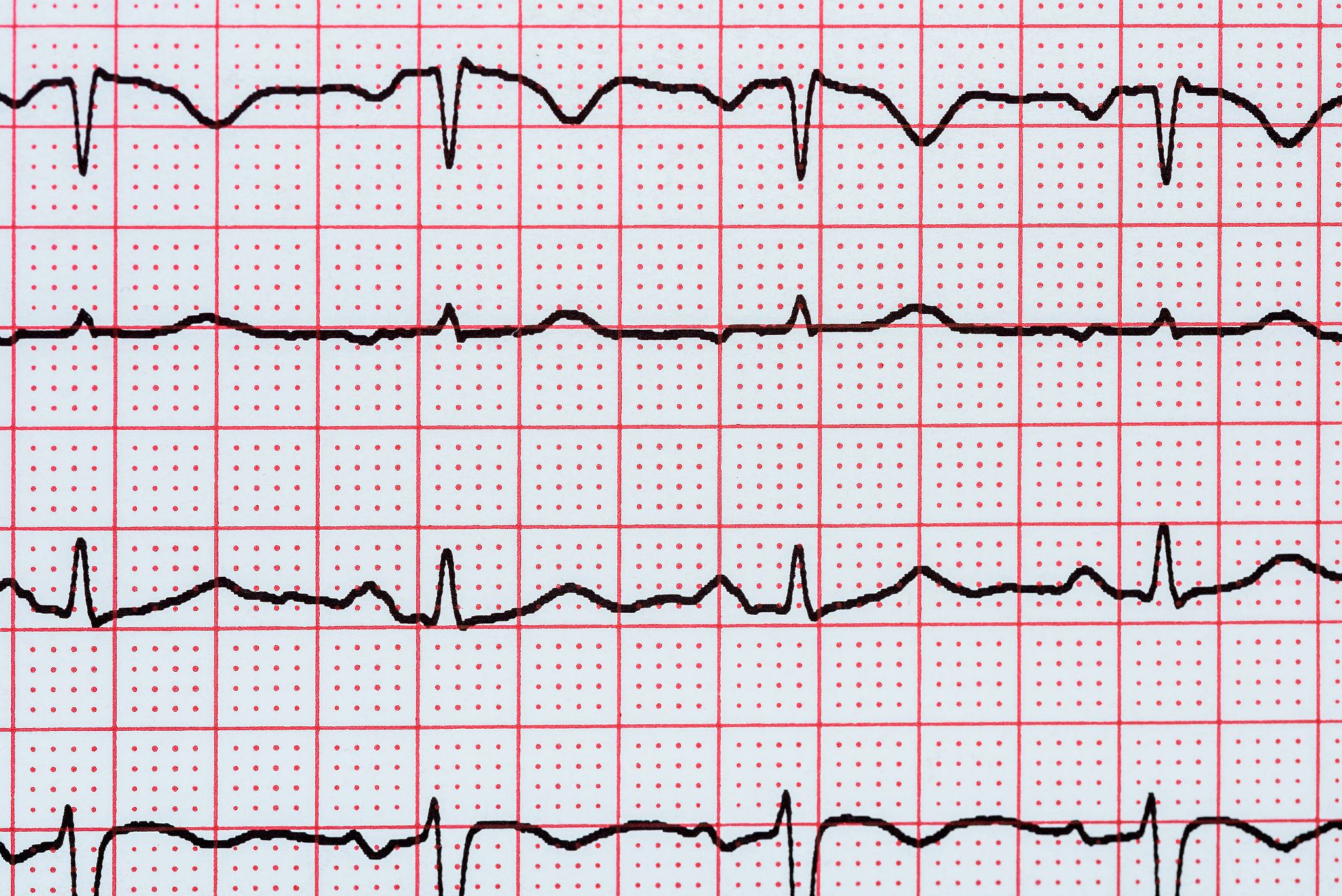 心衰伴心包积液患者的心功能护理指南