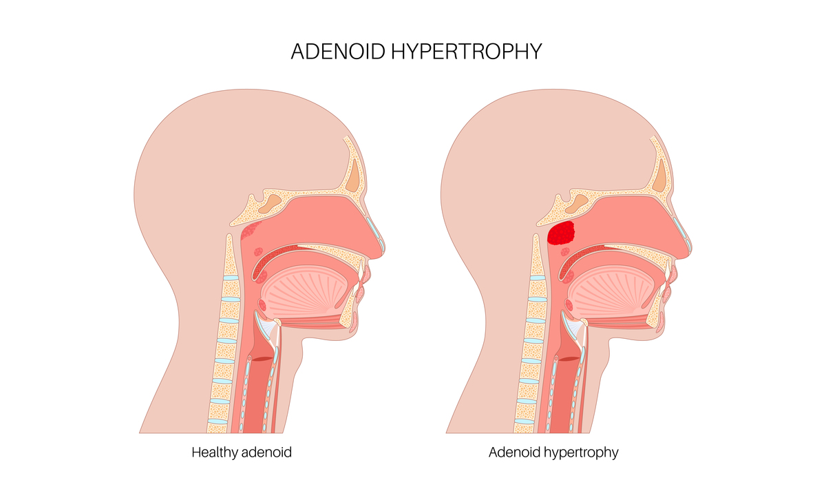 影响气道通畅的因素