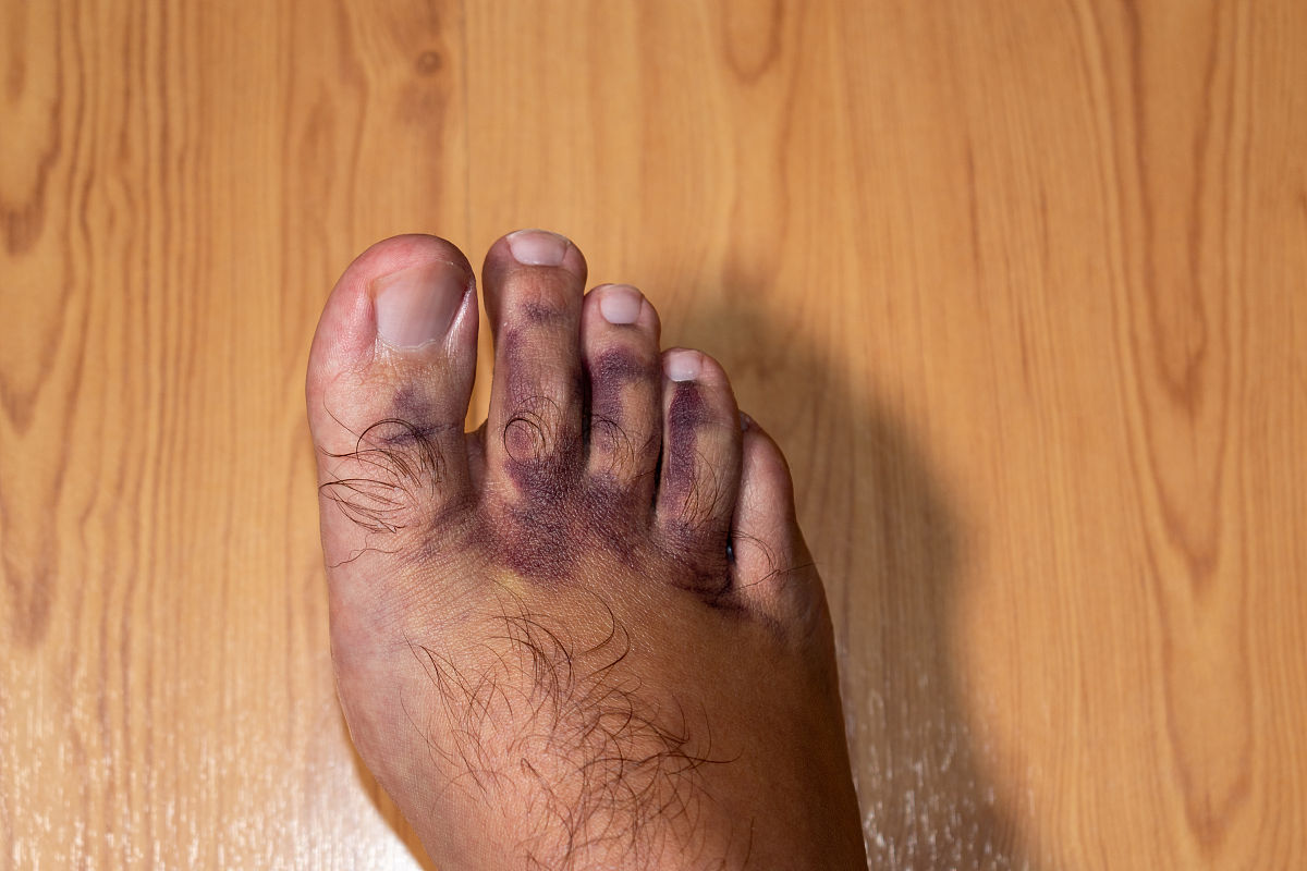 足底角化病治疗方法：药物、手术、按摩和护理