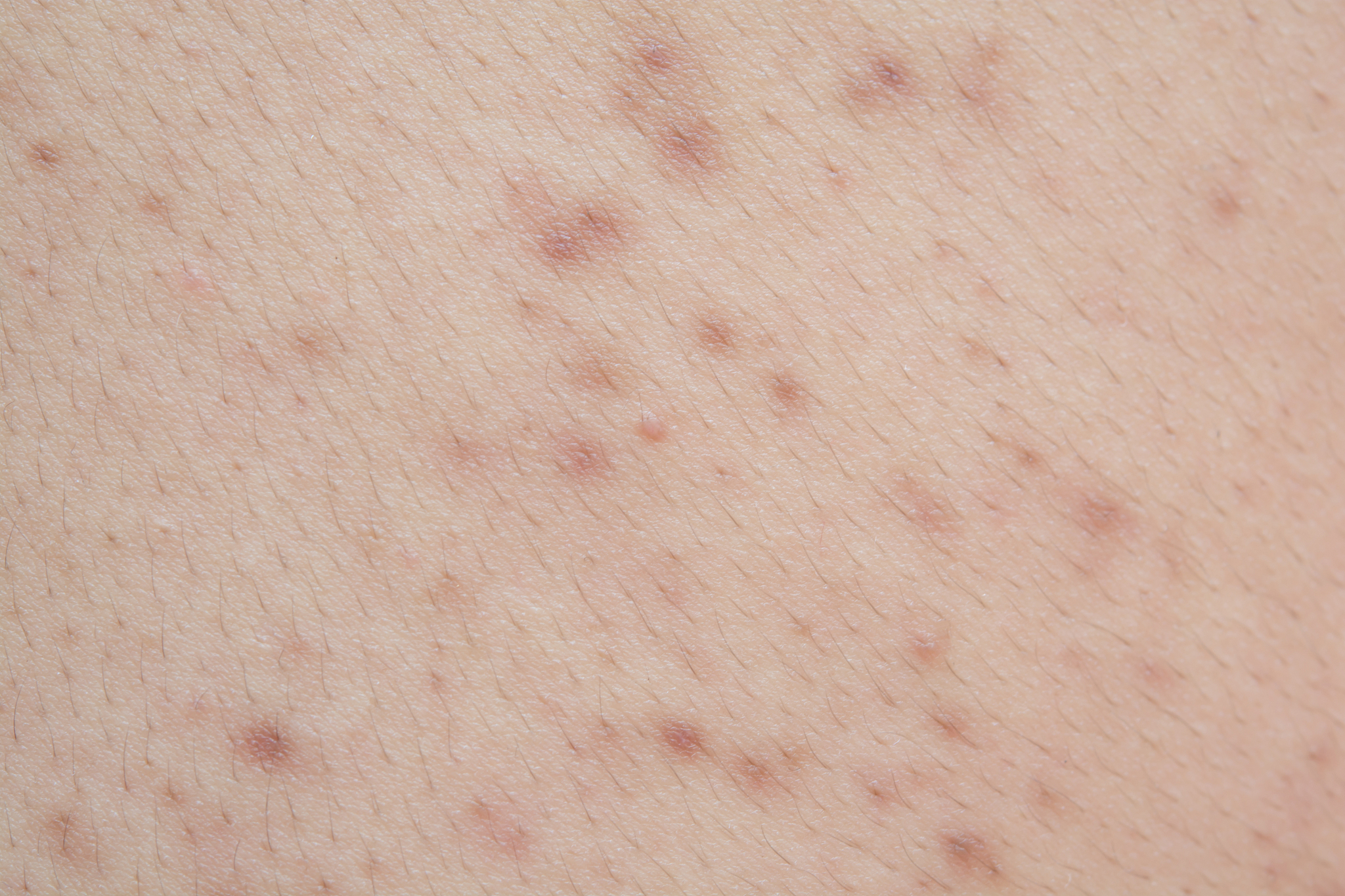 acne on the back