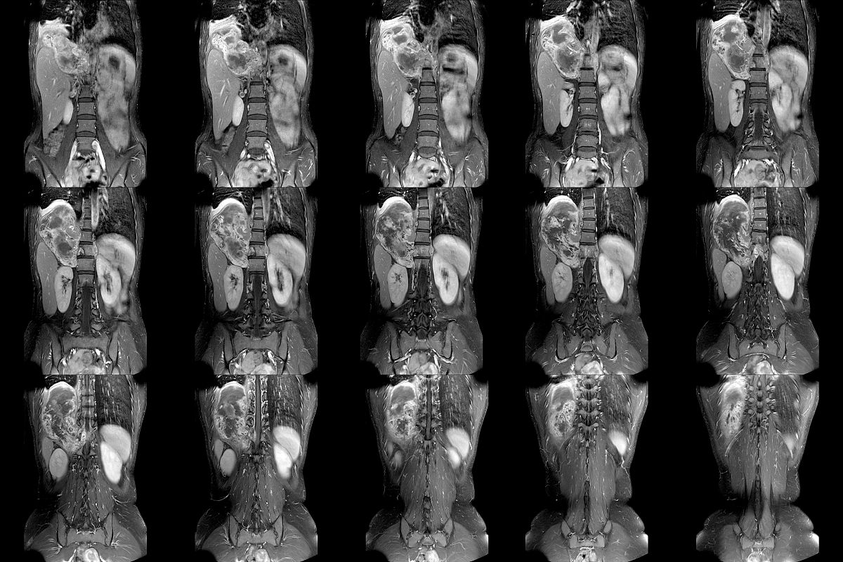 椎体成形术（PVA）适应症和禁忌症：治疗脊柱骨折和椎体压缩性骨折