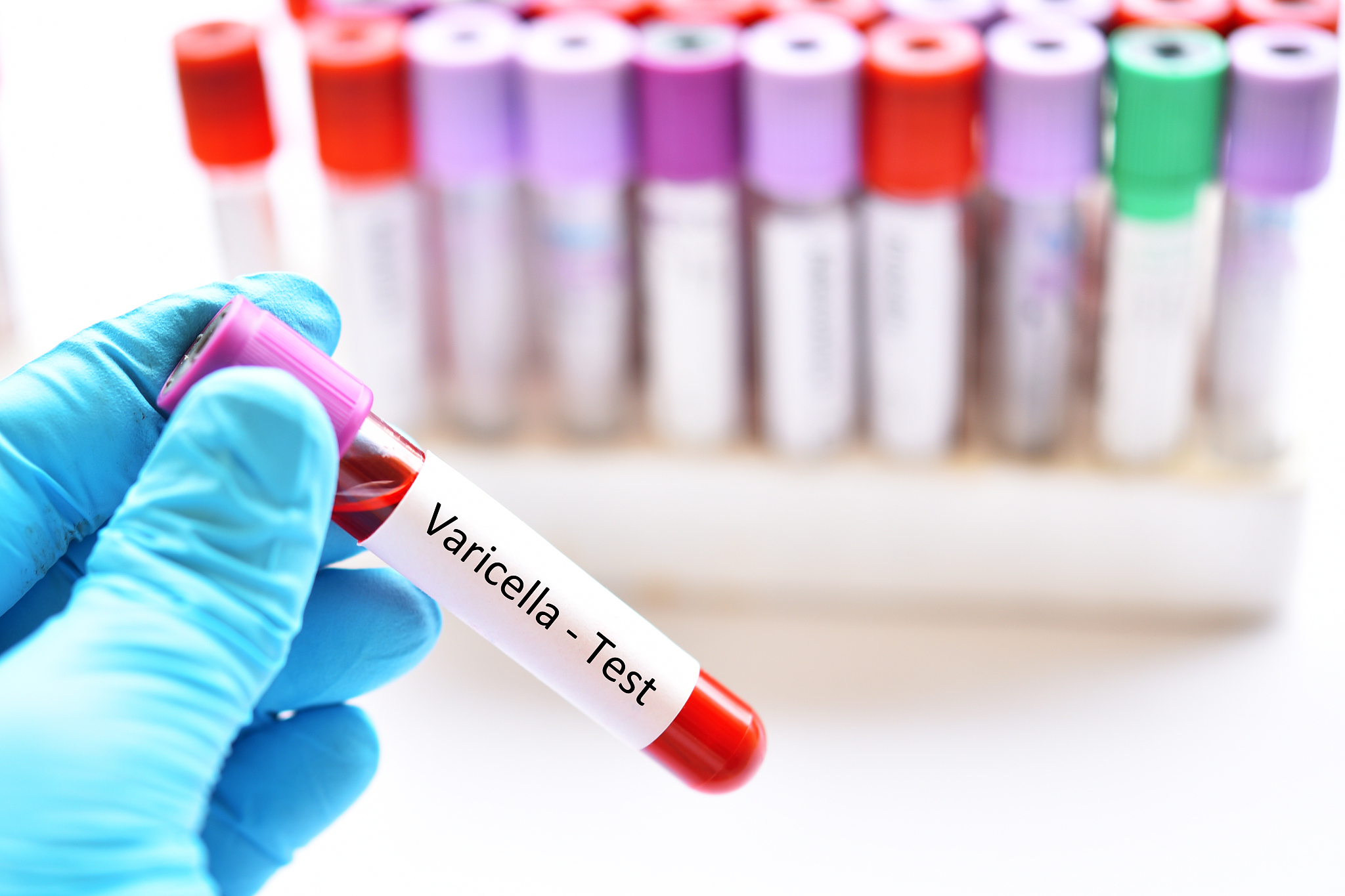 水痘传染病的调查研究的资料收集和整理分析